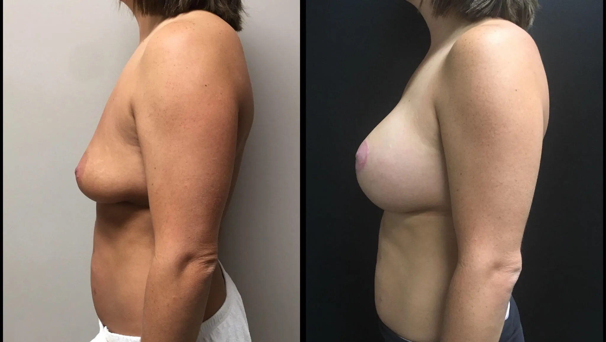 BREAST AUGMENTATION WITH LIFT Before & After Case Number 0005