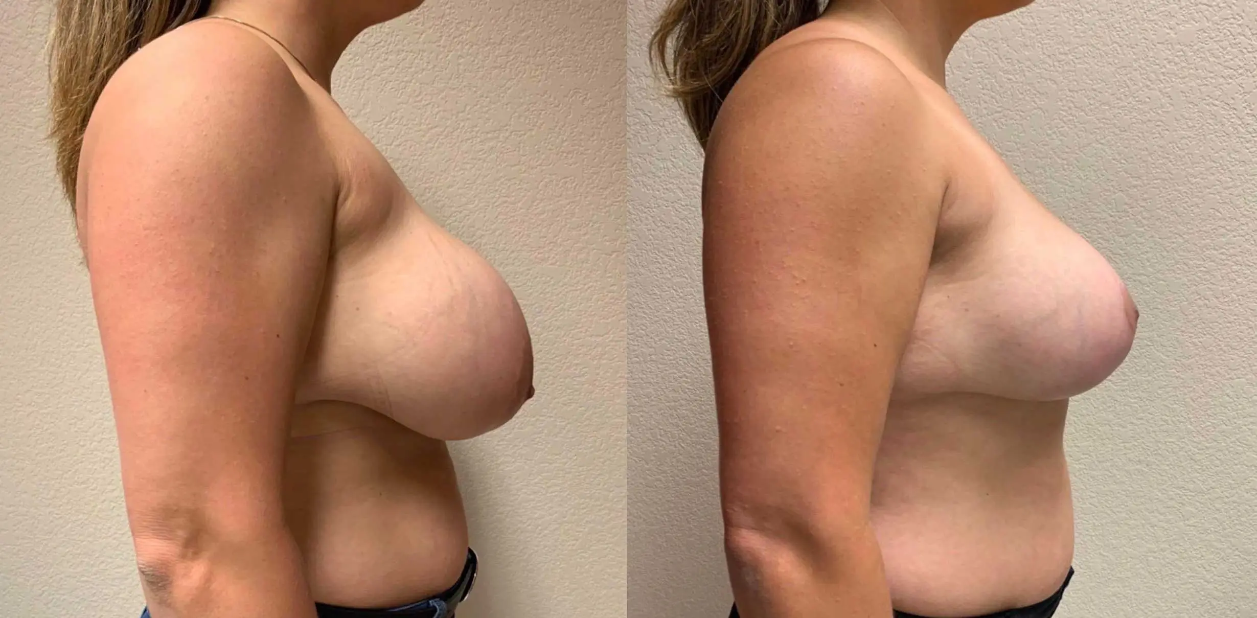 BREAST AUGMENTATION WITH LIFT Before & After Case Number 0006
