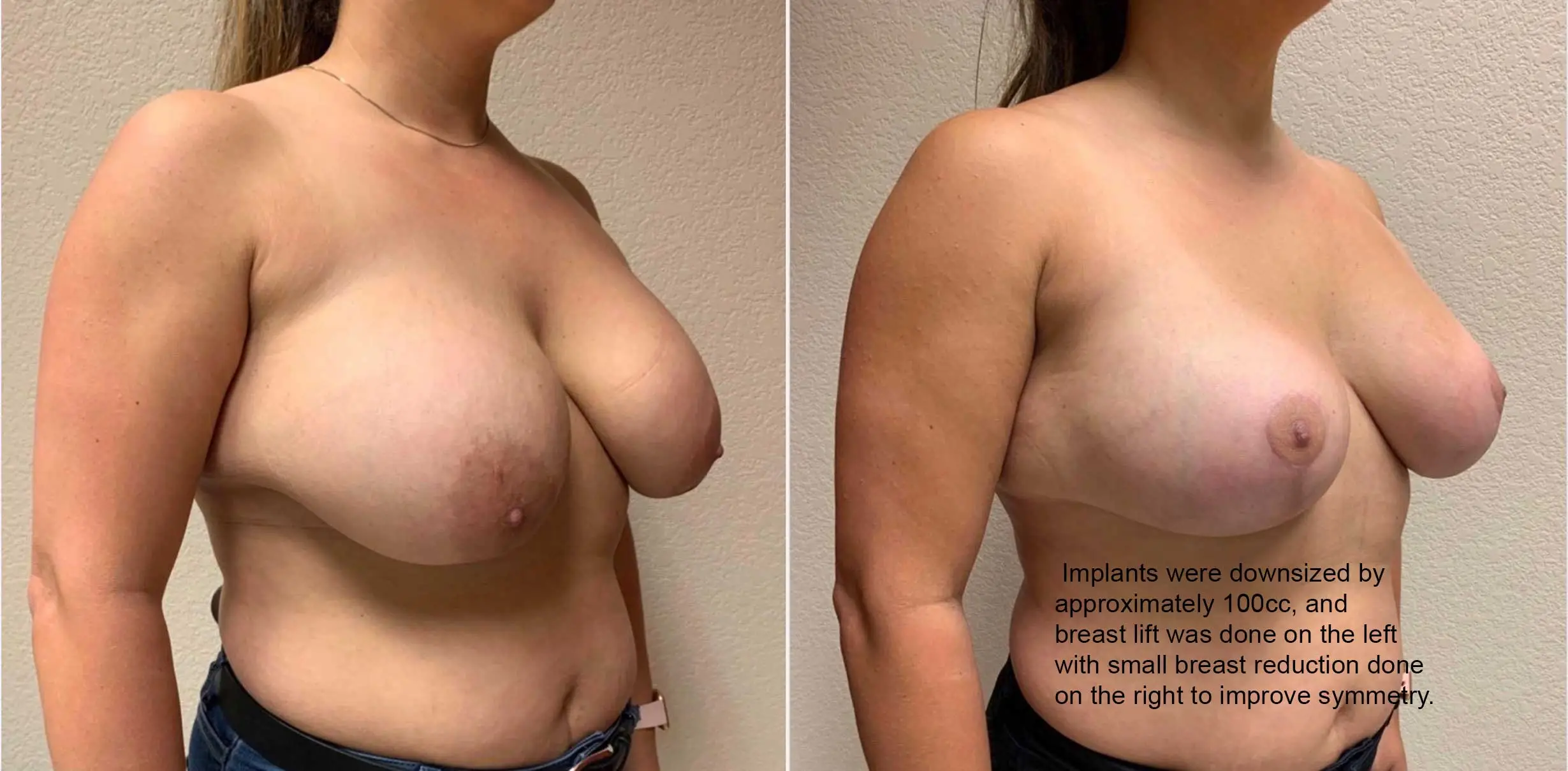 BREAST AUGMENTATION WITH LIFT Before & After Case Number 0006