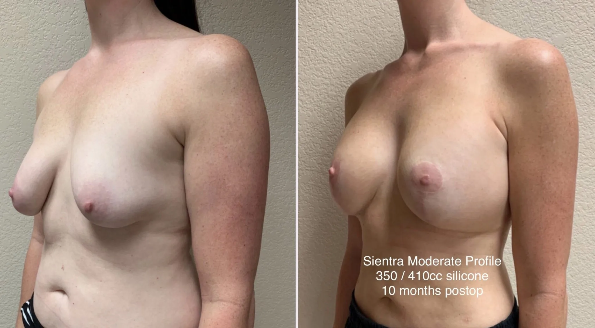 BREAST AUGMENTATION WITH LIFT Before & After Case Number 0007