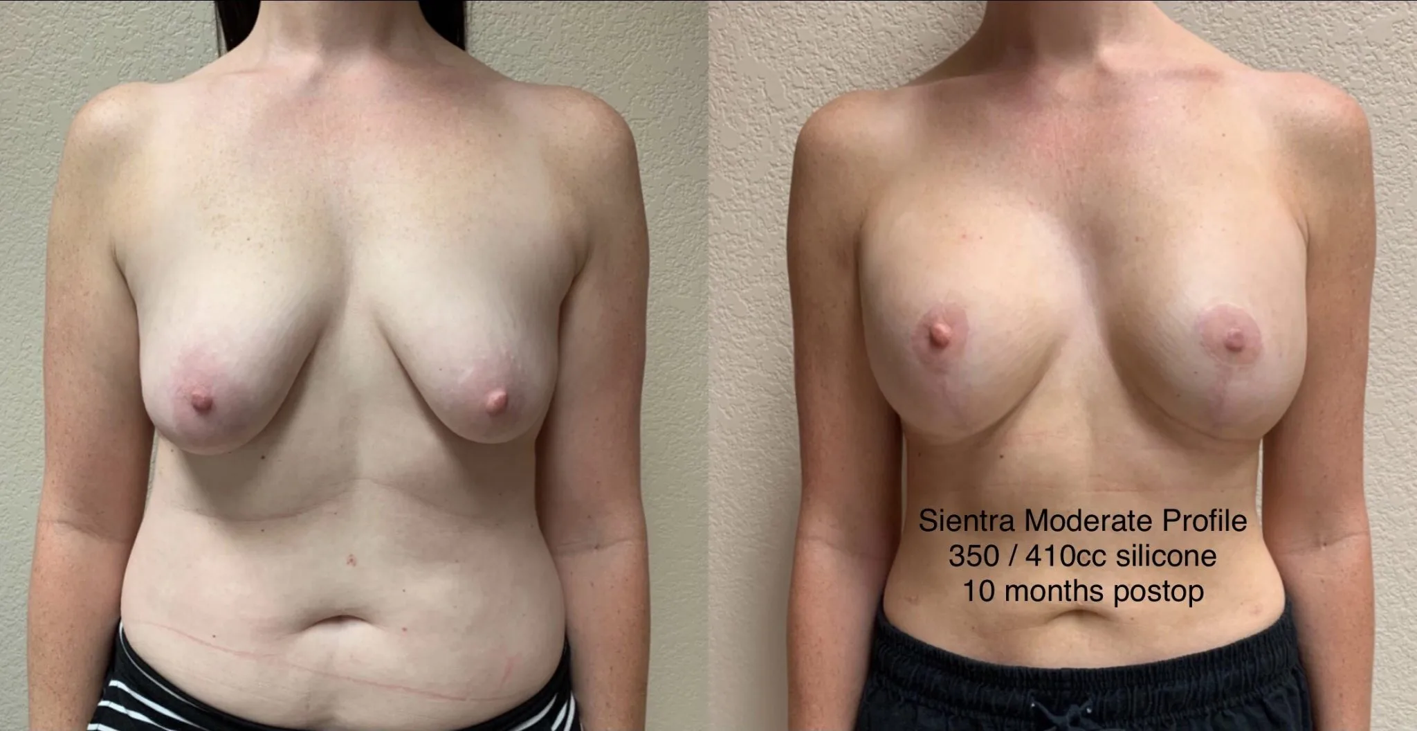 BREAST AUGMENTATION WITH LIFT Before & After Case Number 0007