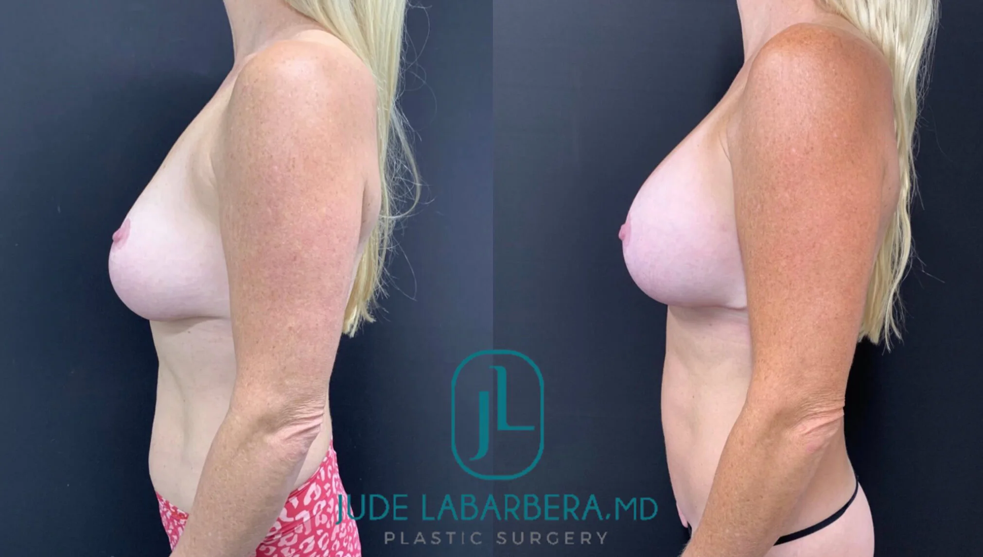 BREAST AUGMENTATION WITH REVISION LIFT AND MINI TUMMY TUCK Before & After Case Number 00064