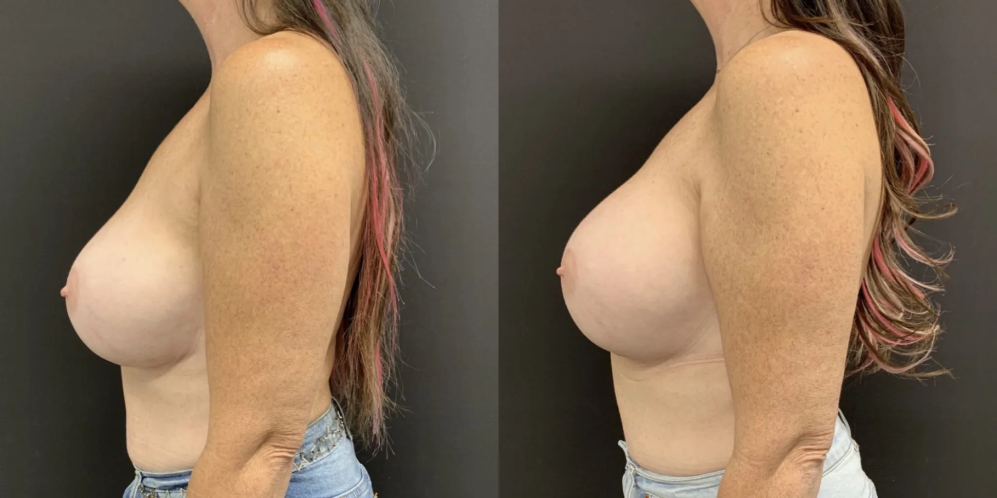 BREAST IMPLANT EXCHANGE Before & After Case Number 00010