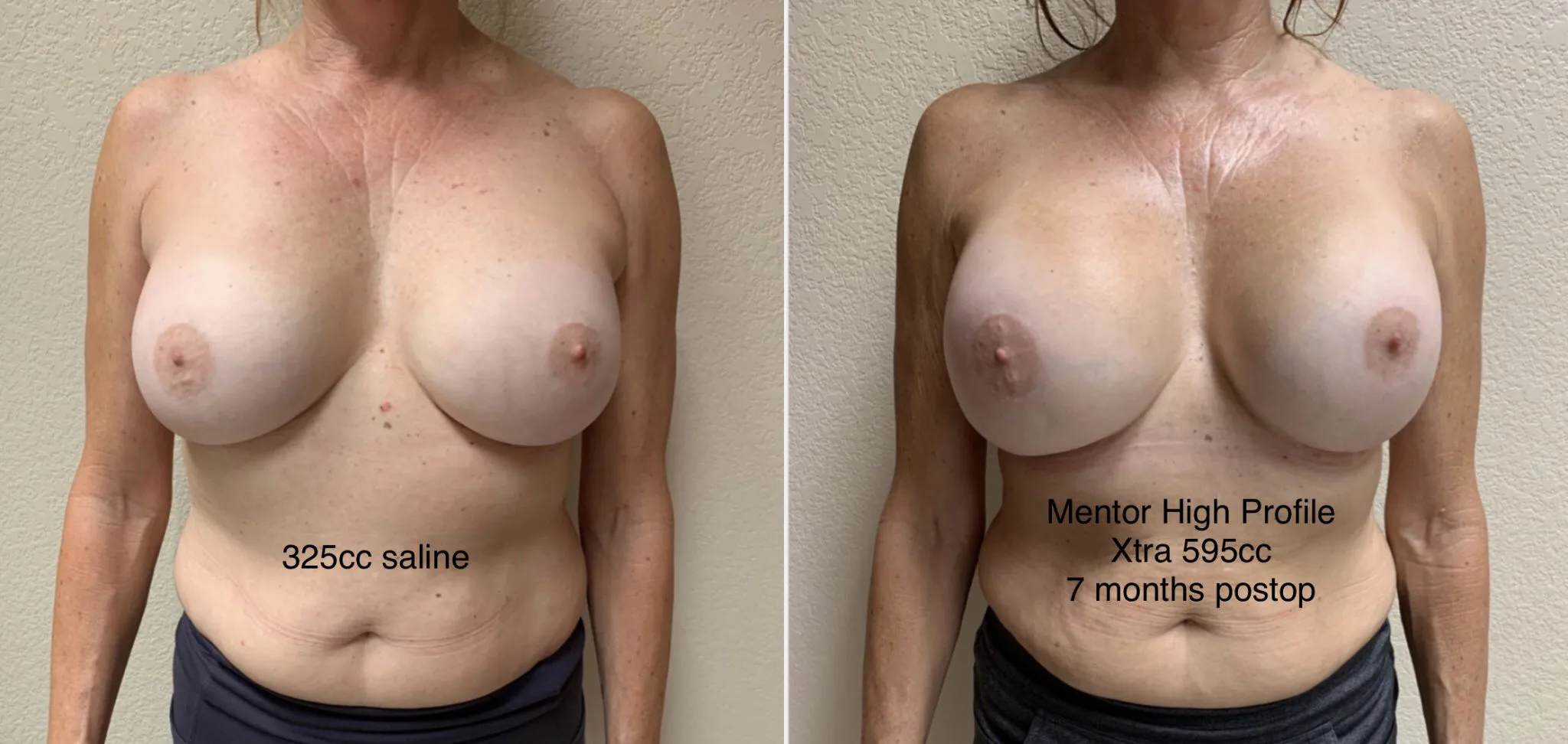 BREAST IMPLANT EXCHANGE Before & After Case Number 0008