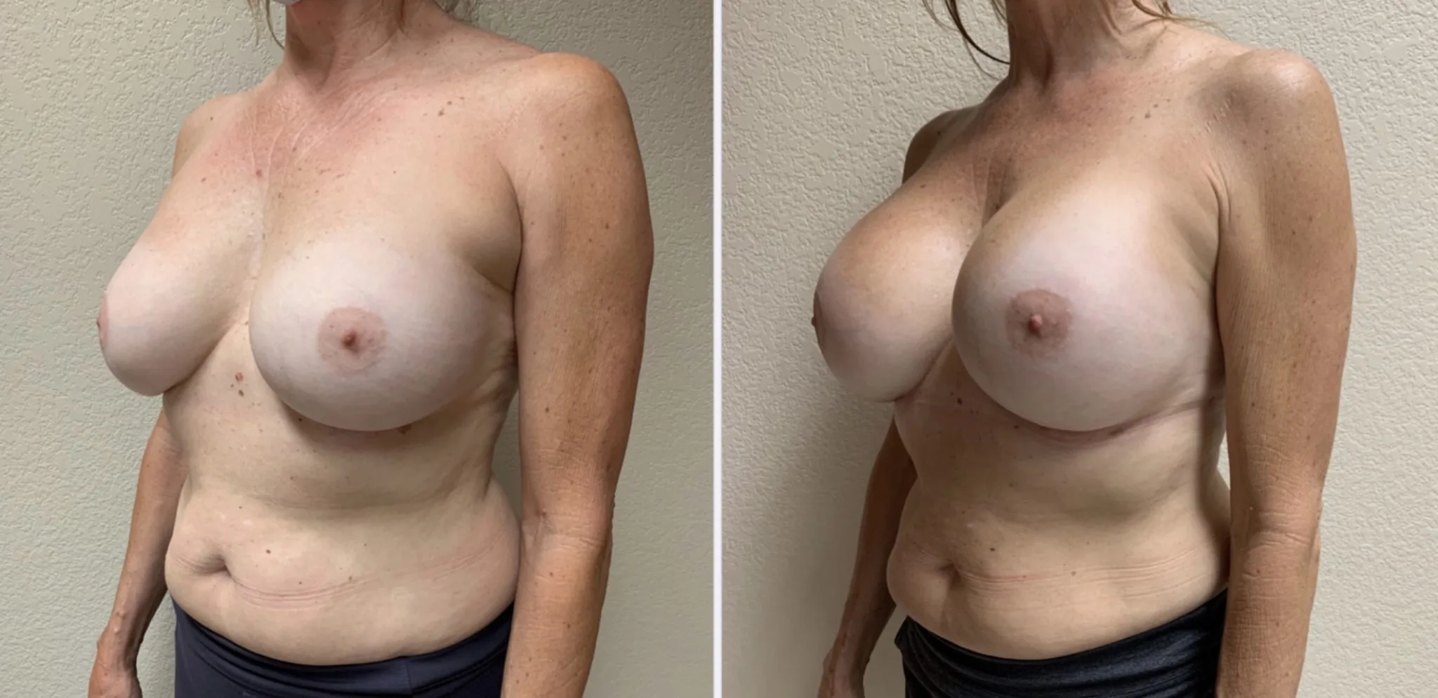 BREAST IMPLANT EXCHANGE Before & After Case Number 0008