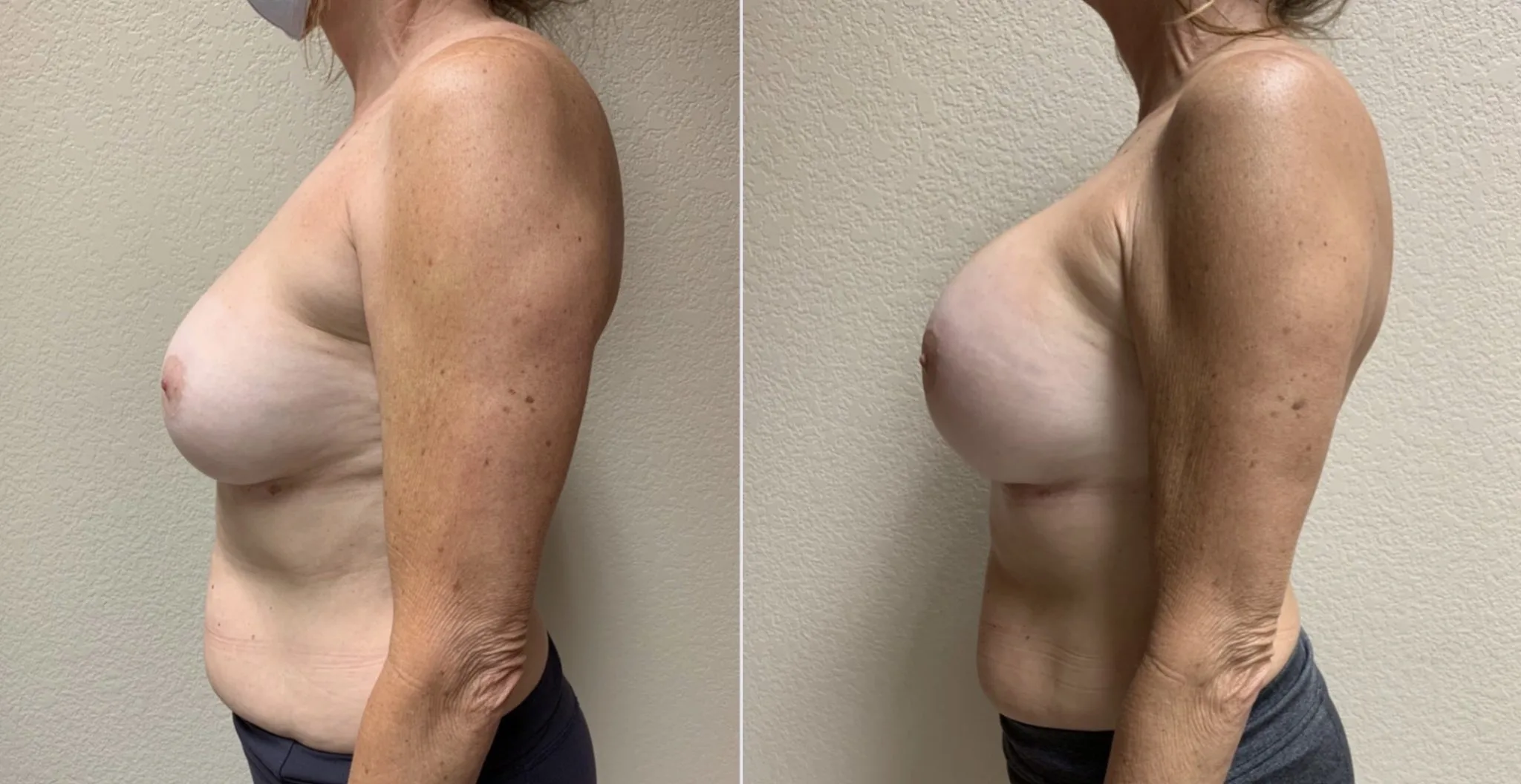 BREAST IMPLANT EXCHANGE Before & After Case Number 0008