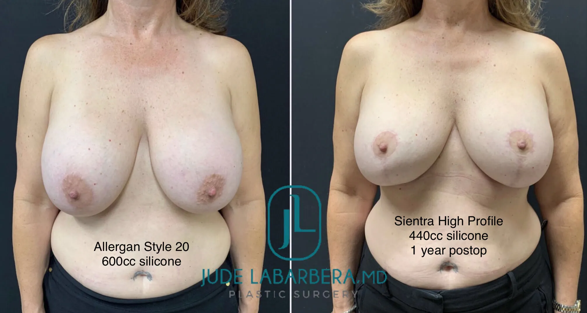 BREAST IMPLANT EXCHANGE WITH LIFT Before & After Case Number 00014