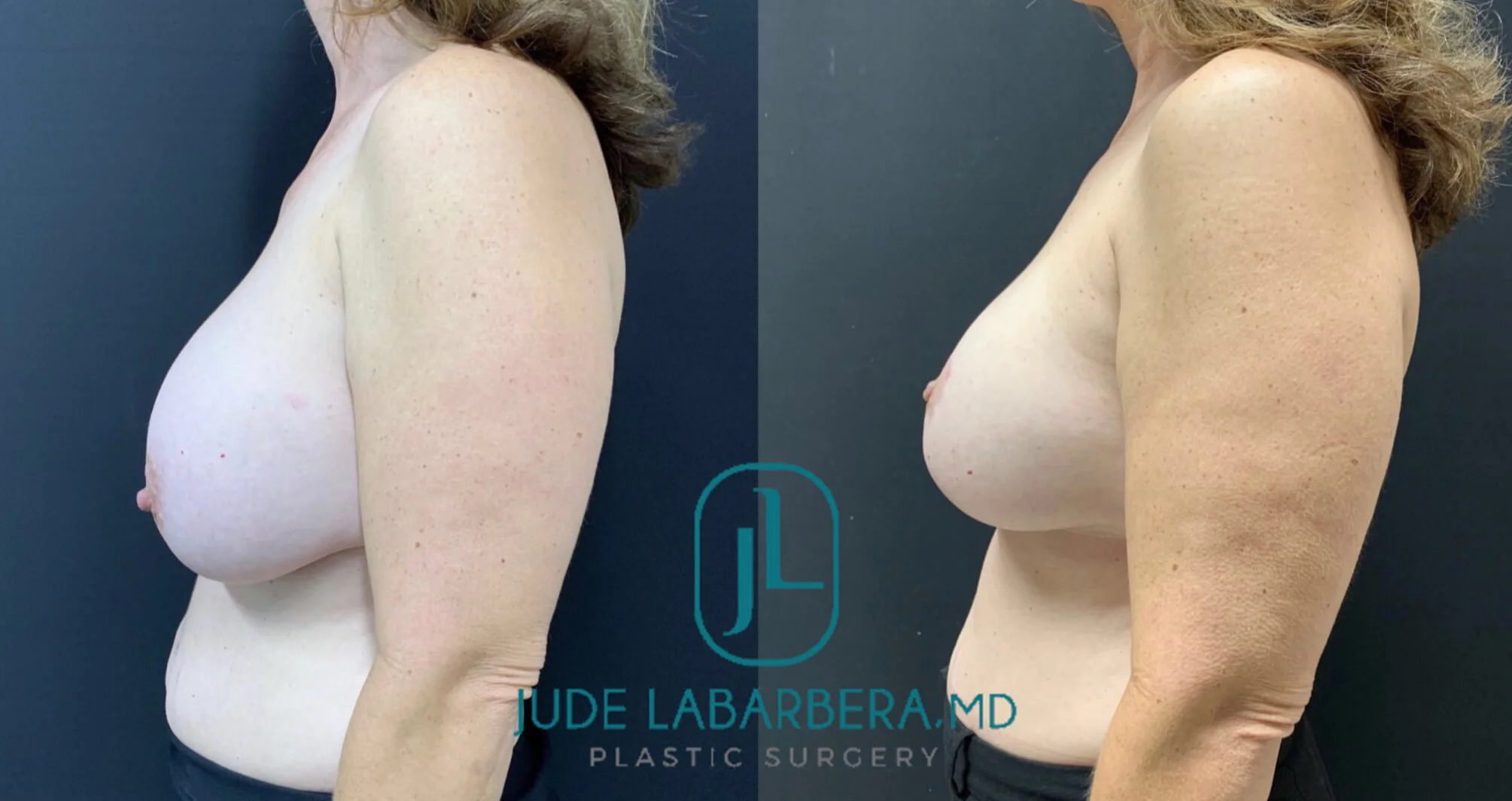 BREAST IMPLANT EXCHANGE WITH LIFT Before & After Case Number 00014