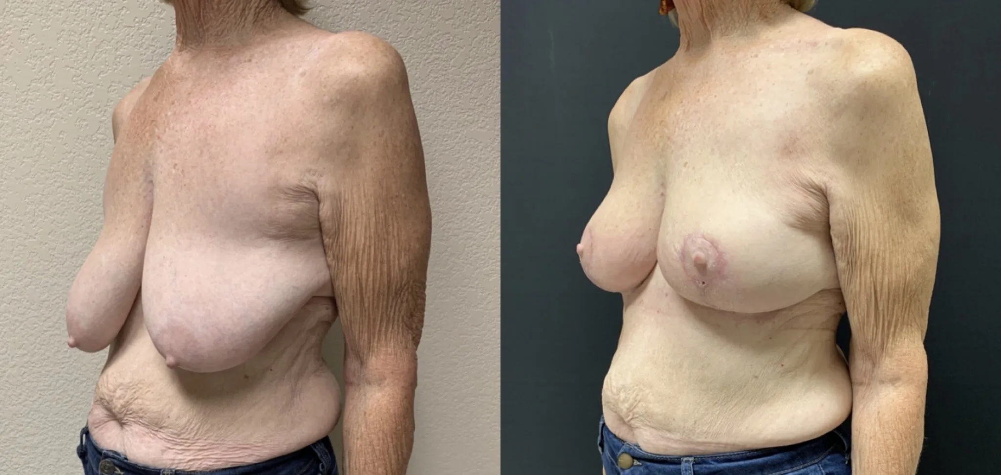 BREAST LIFT Before & After Case Number 00010