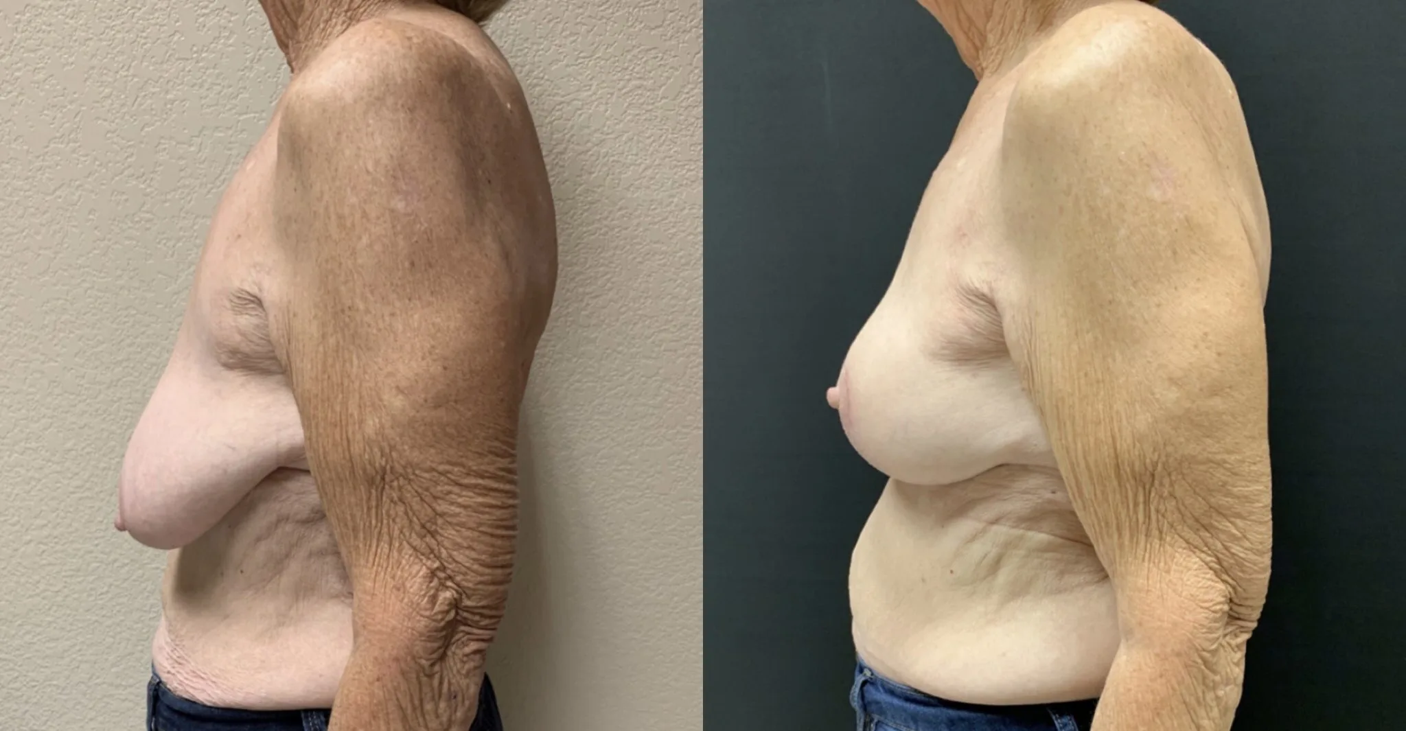 BREAST LIFT Before & After Case Number 00010