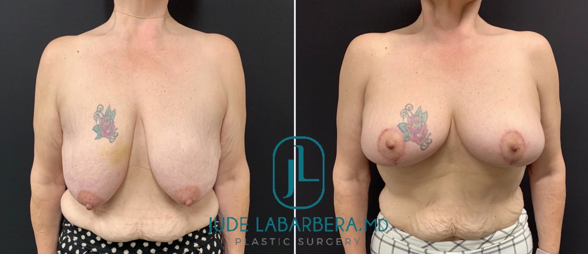 BREAST LIFT Before & After Case Number 00011