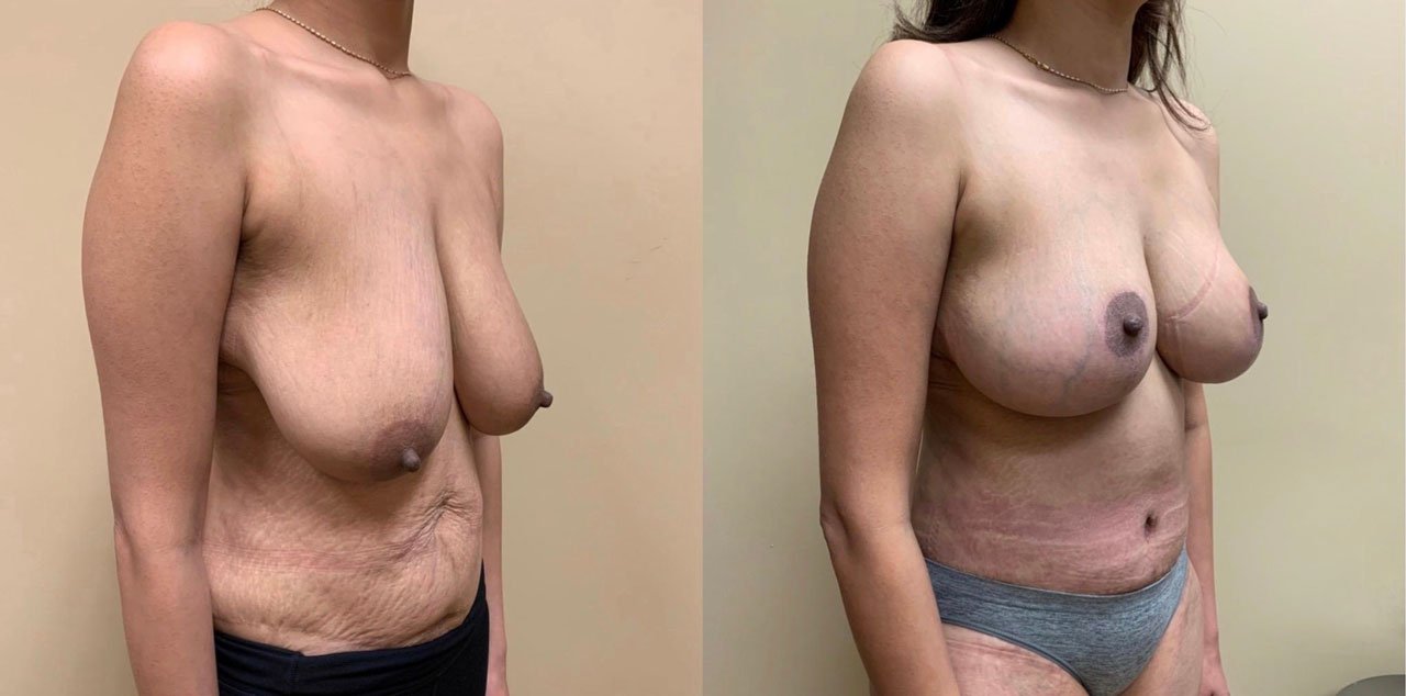 BREAST LIFT Before & After Case Number 0005-BL