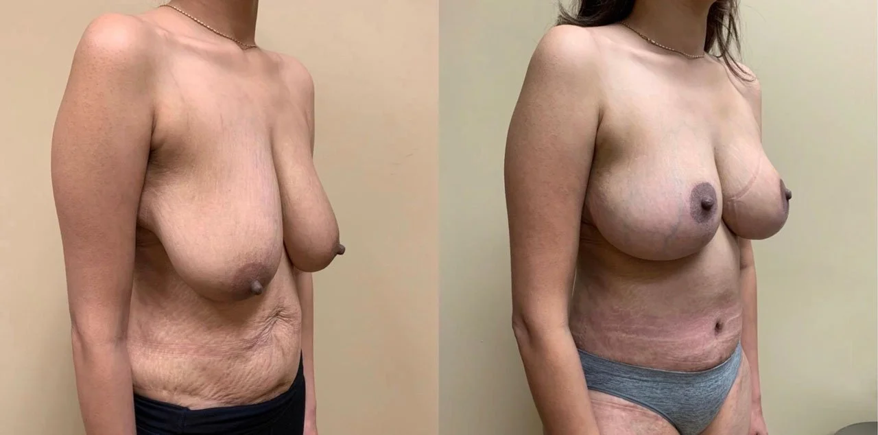BREAST LIFT Before & After Case Number 0005-BL