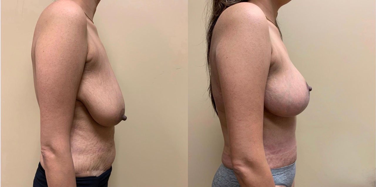 BREAST LIFT Before & After Case Number 0005-BL