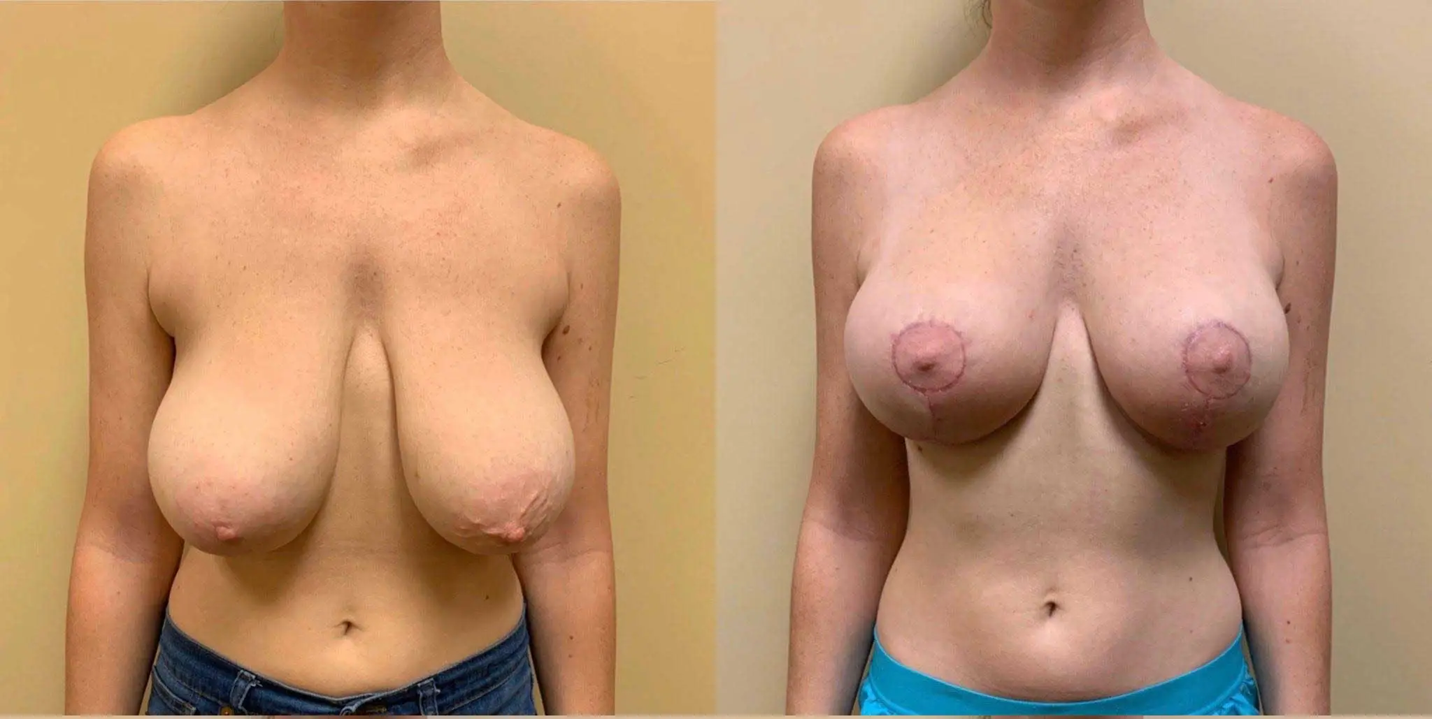 BREAST LIFT Before & After Case Number 0006