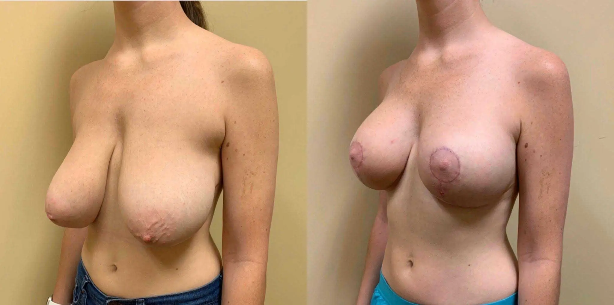 BREAST LIFT Before & After Case Number 0006