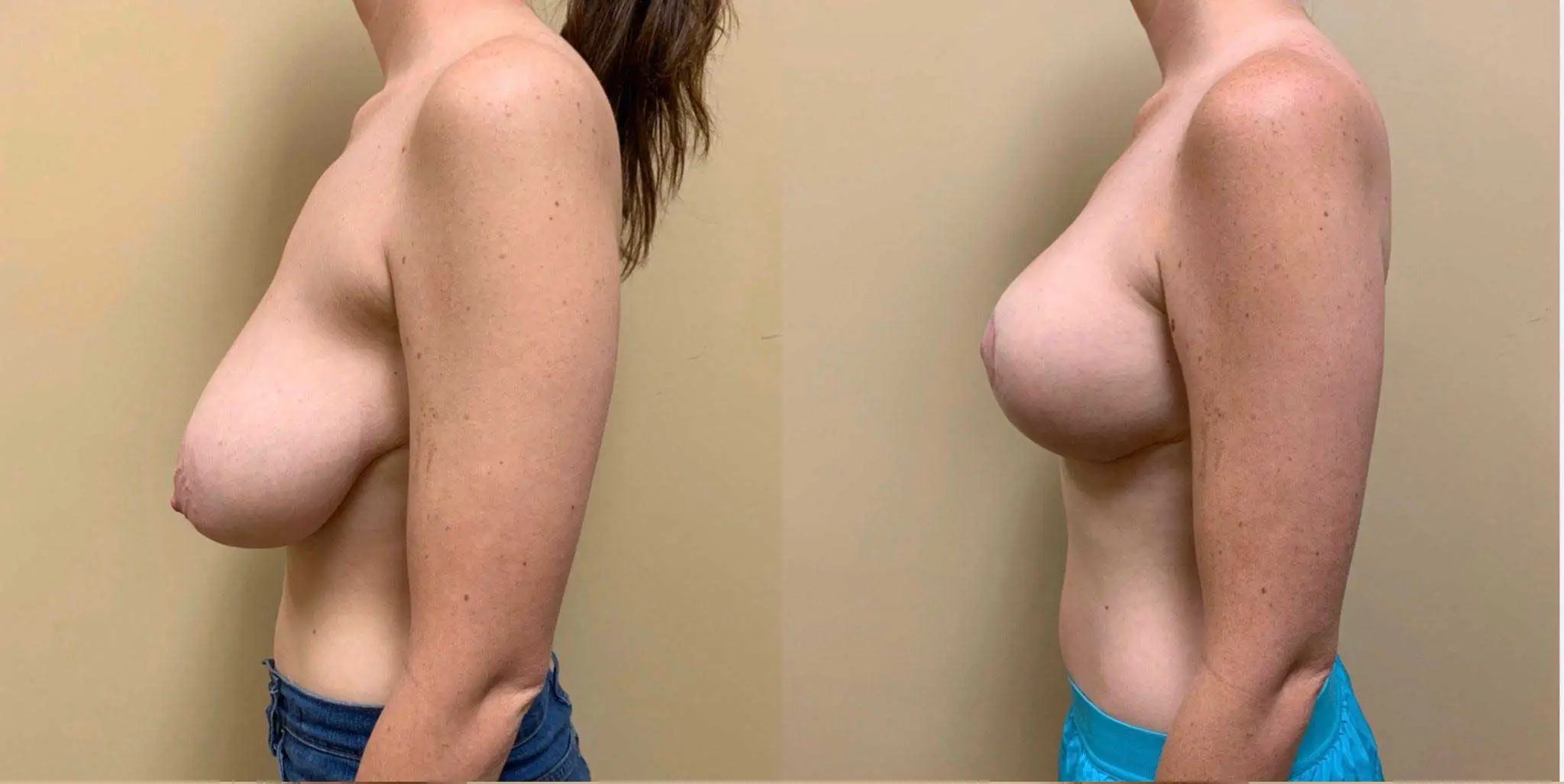 BREAST LIFT Before & After Case Number 0006