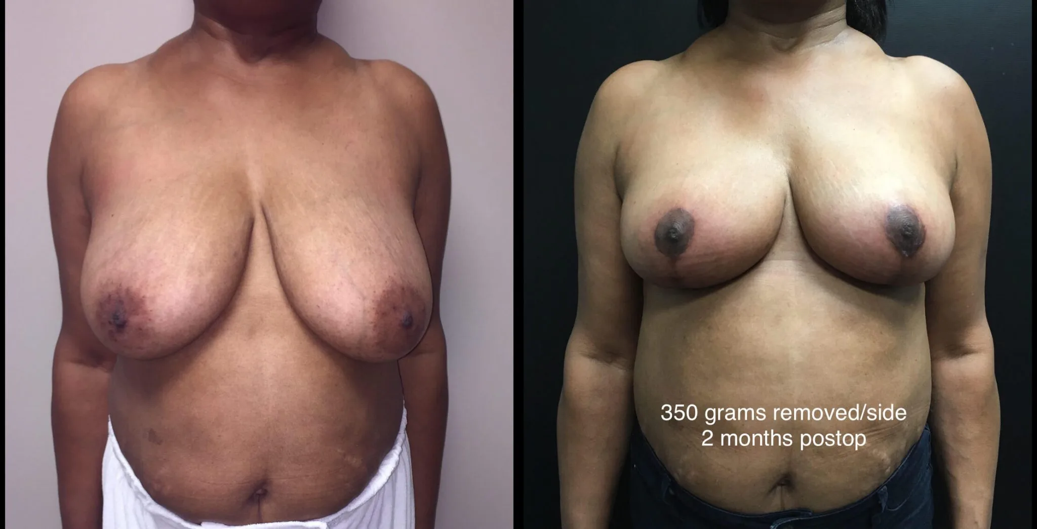 BREAST LIFT Before & After Case Number 0007