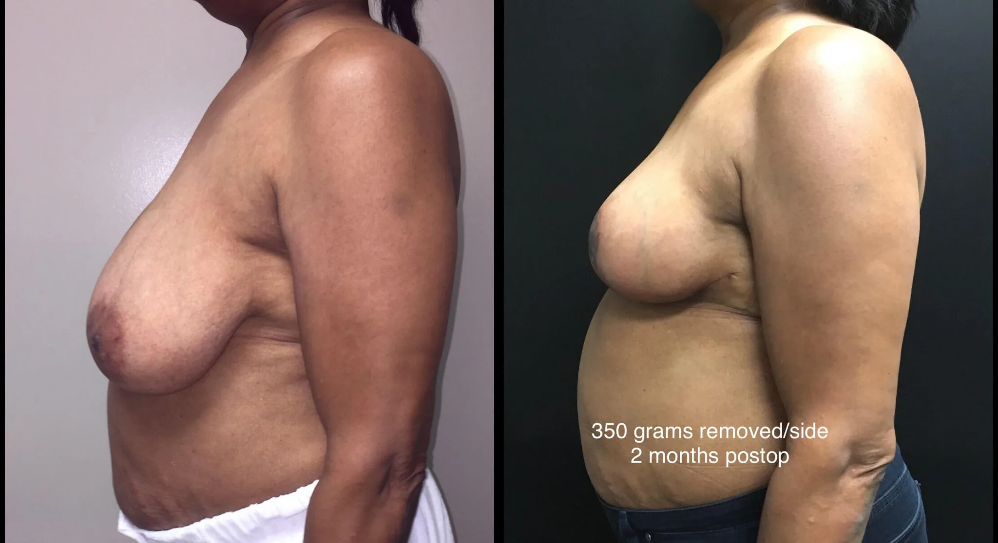 BREAST LIFT Before & After Case Number 0007