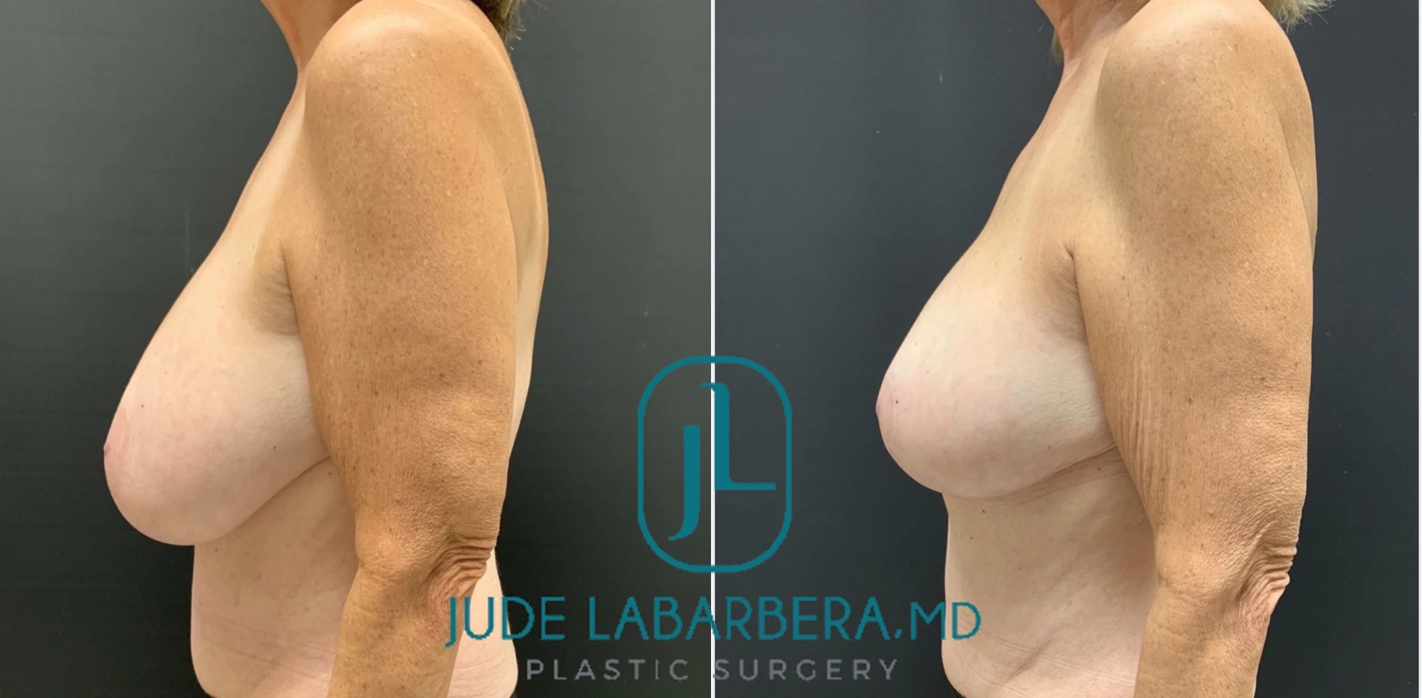 BREAST lift with REDUCTION Before & After Case Number 0009