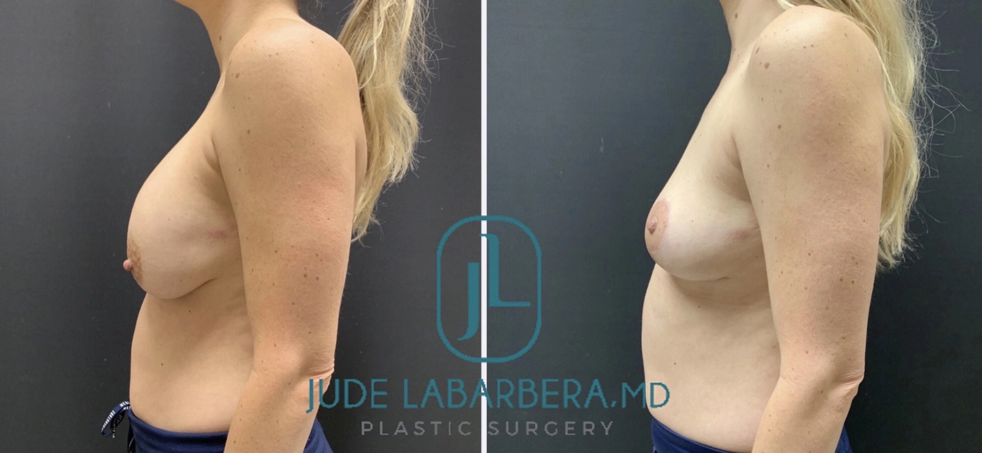 Breast Procedure Before & After Case Number 00014