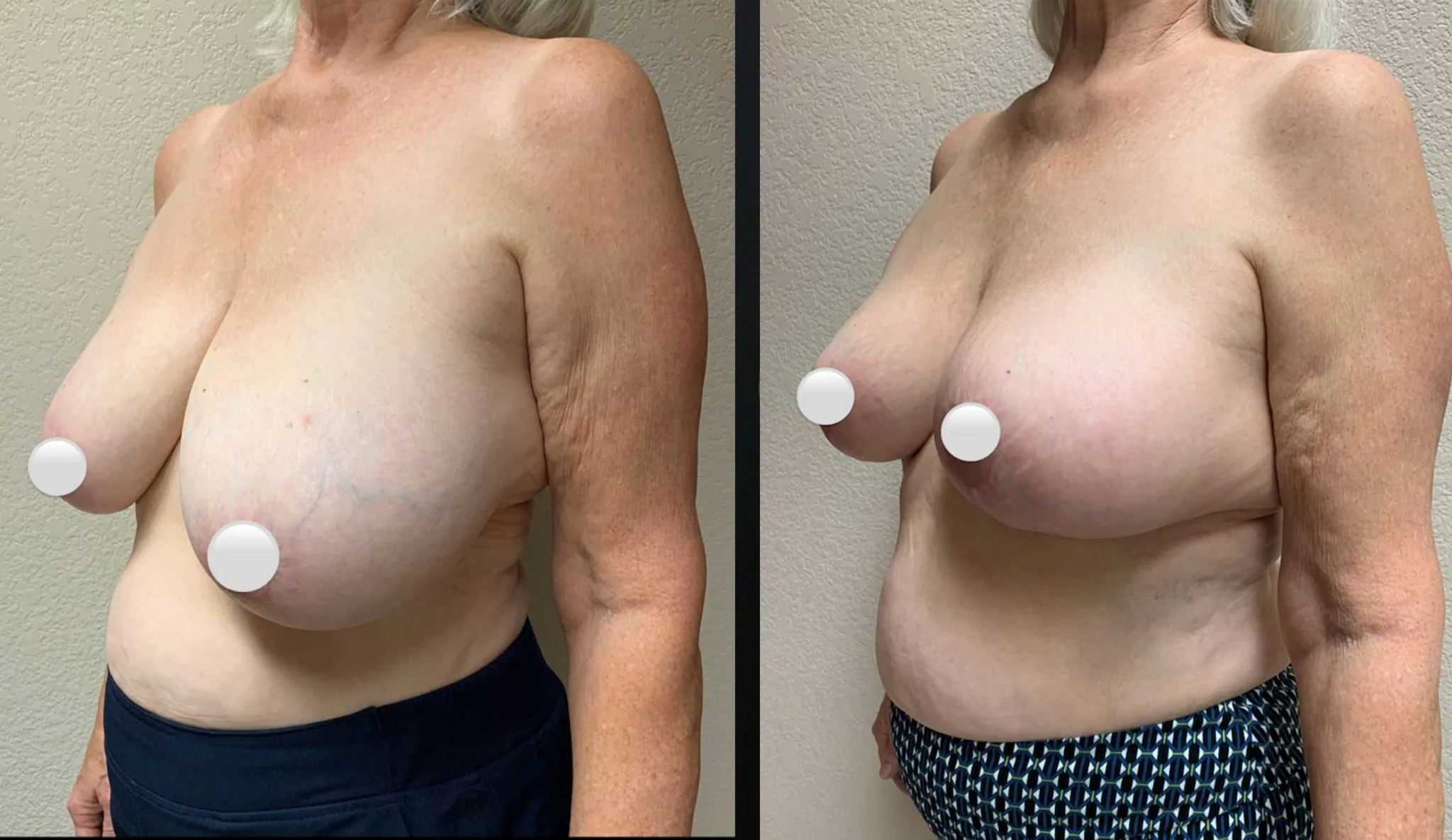 BREAST RECONSTRUCTION Before & After Case Number 0005
