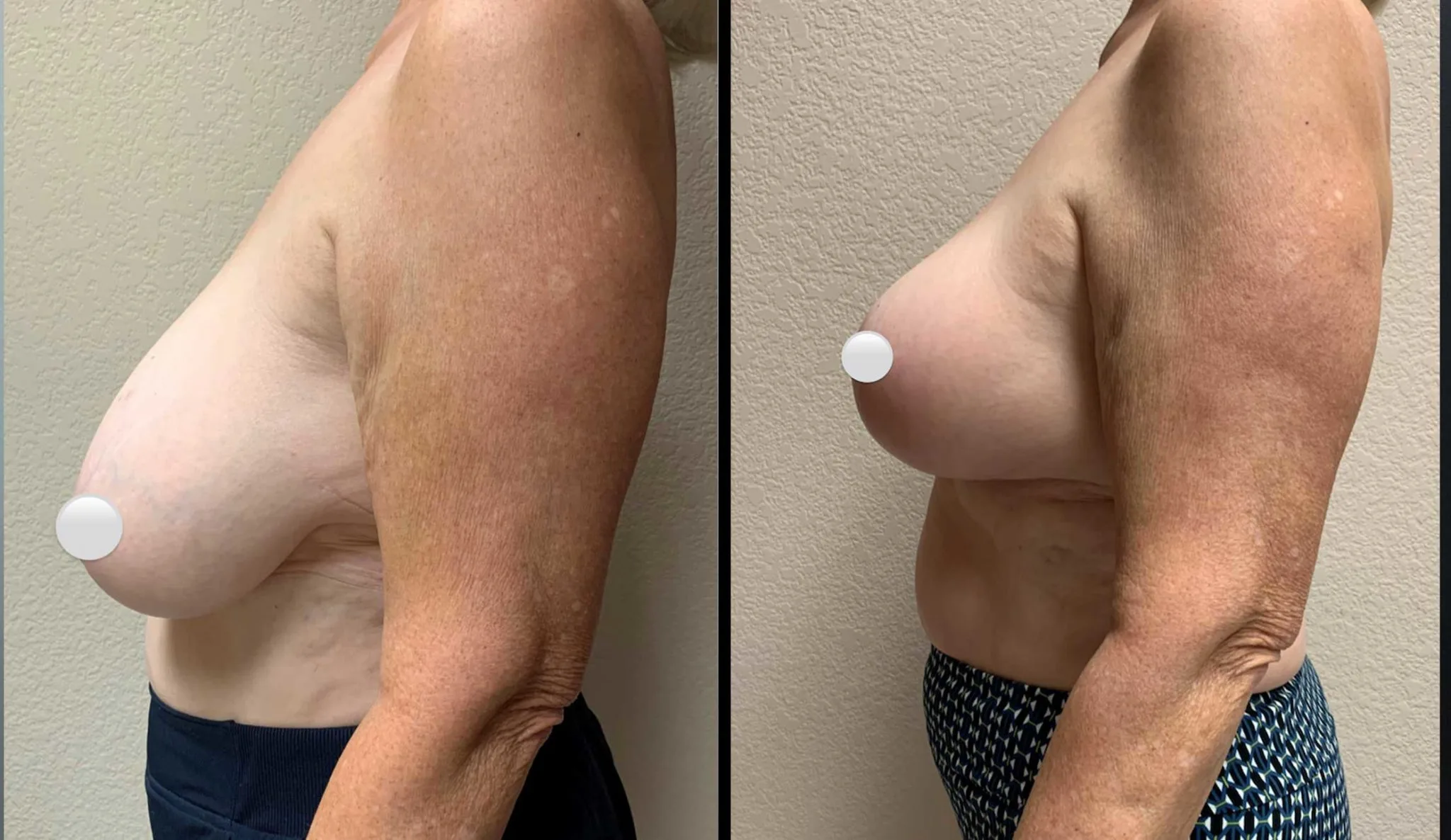 BREAST RECONSTRUCTION Before & After Case Number 0005