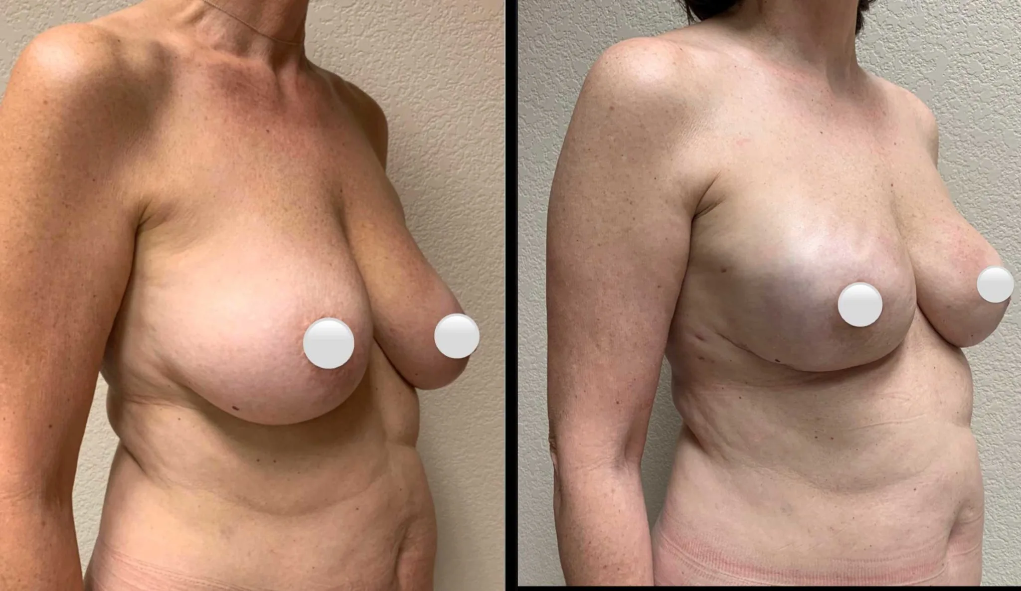 BREAST RECONSTRUCTION Before & After Case Number 0006