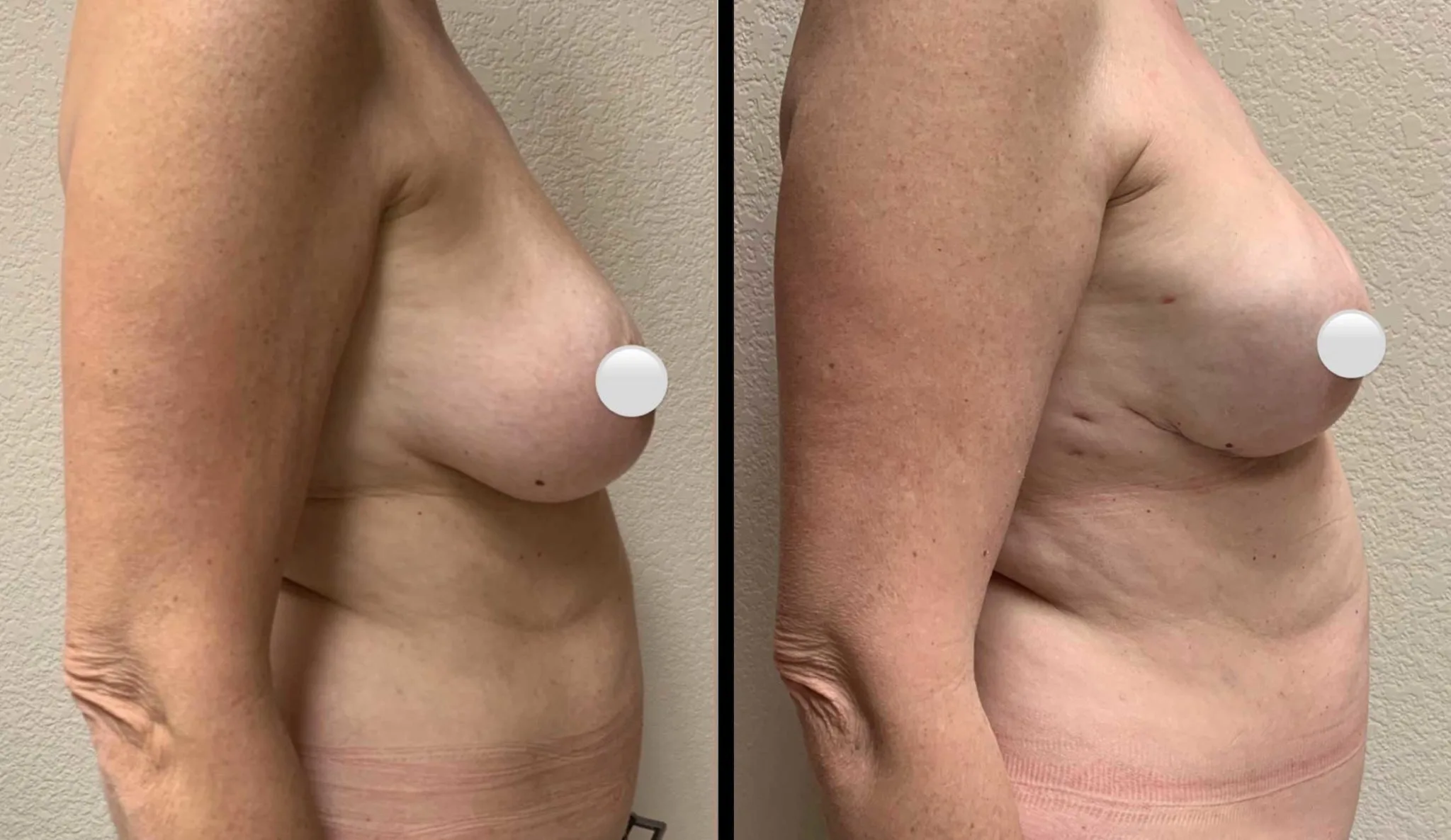 BREAST RECONSTRUCTION Before & After Case Number 0006