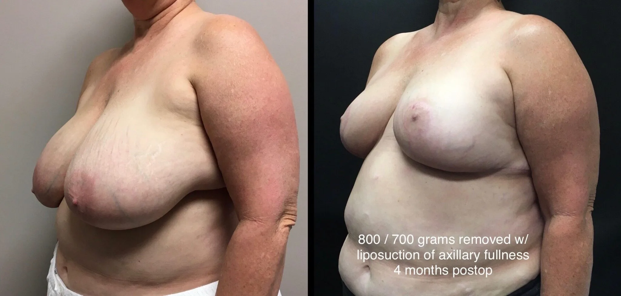 BREAST REDUCTION Before & After Case Number 0001