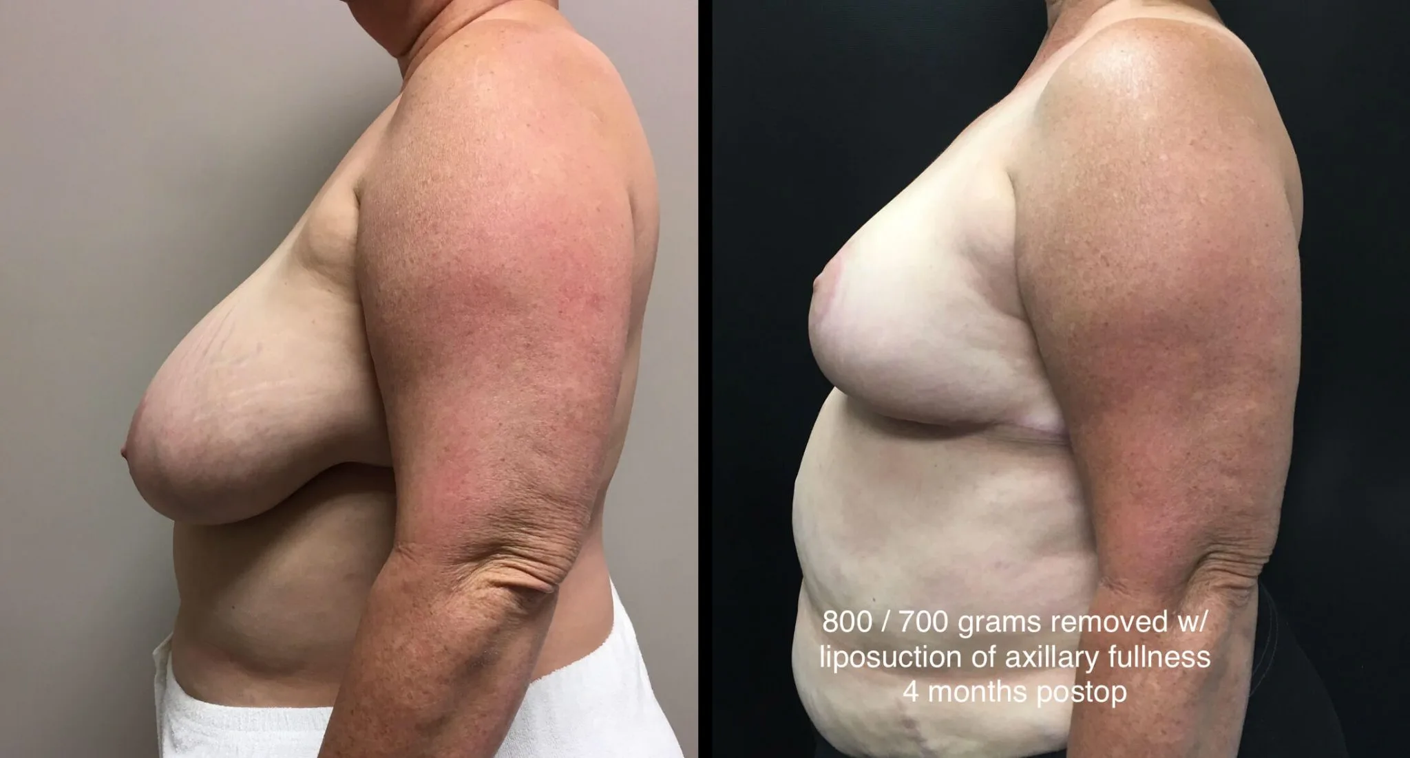 BREAST REDUCTION Before & After Case Number 0001