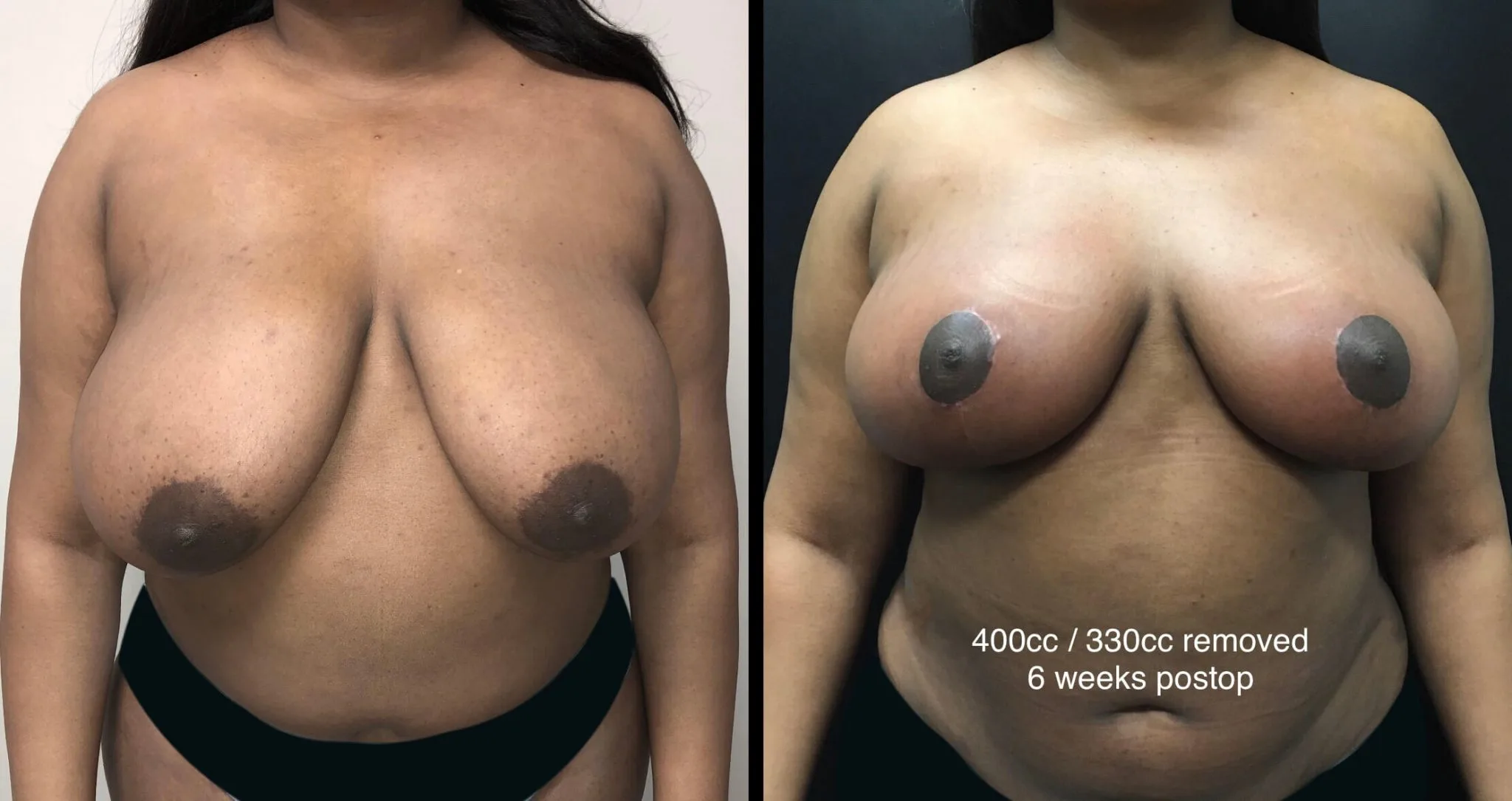 BREAST REDUCTION Before & After Case Number 0002