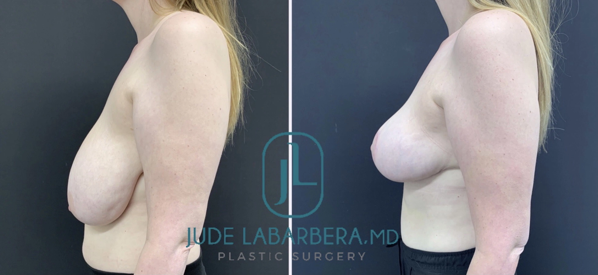 BREAST REDUCTION Before & After Case Number 0002