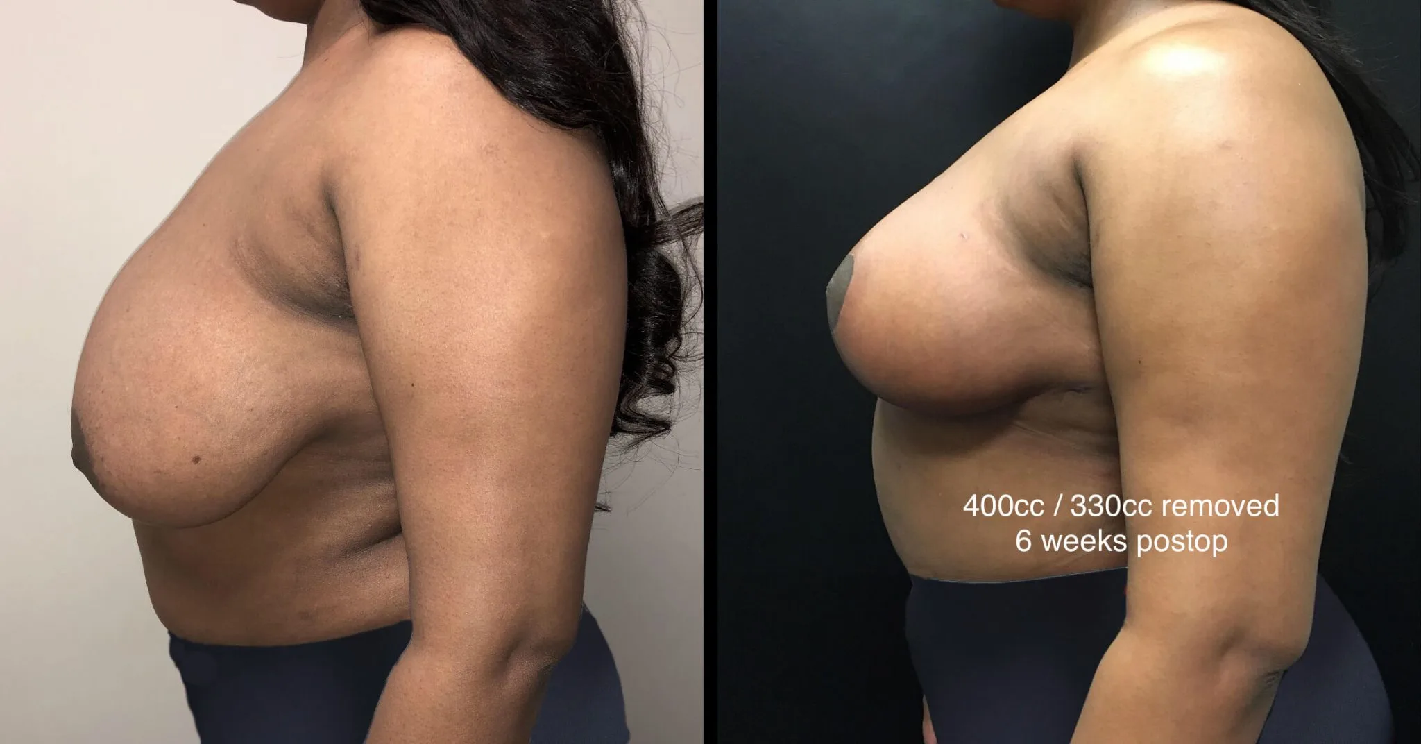 BREAST REDUCTION Before & After Case Number 0002