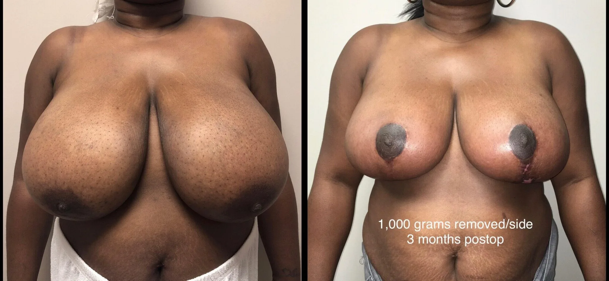 BREAST REDUCTION Before & After Case Number 0003