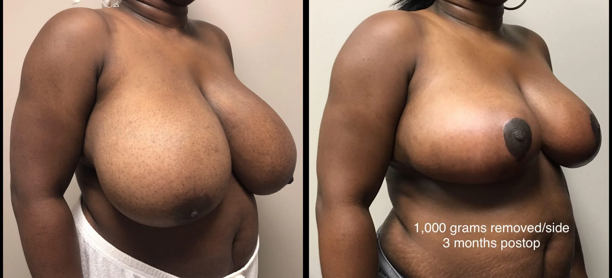 BREAST REDUCTION Before & After Case Number 0003