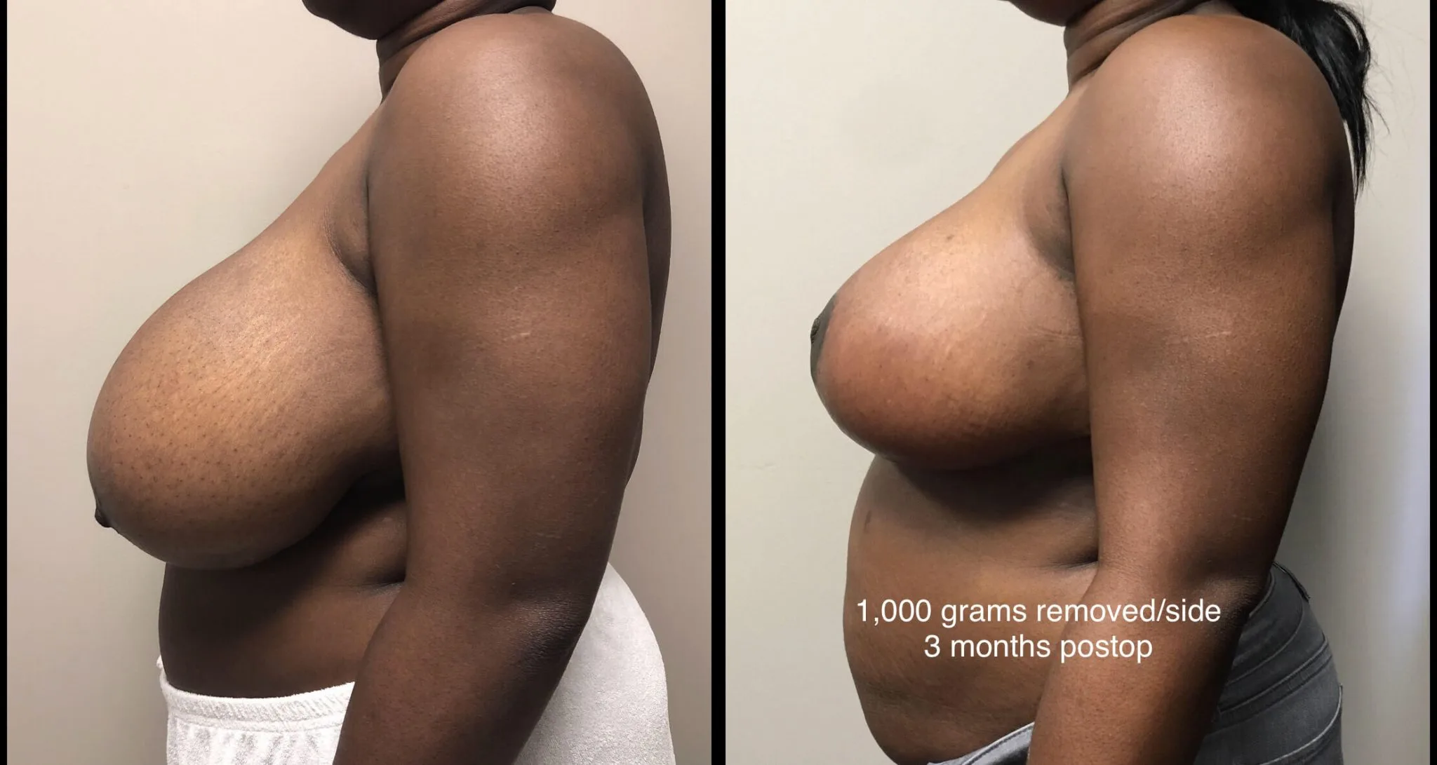 BREAST REDUCTION Before & After Case Number 0003