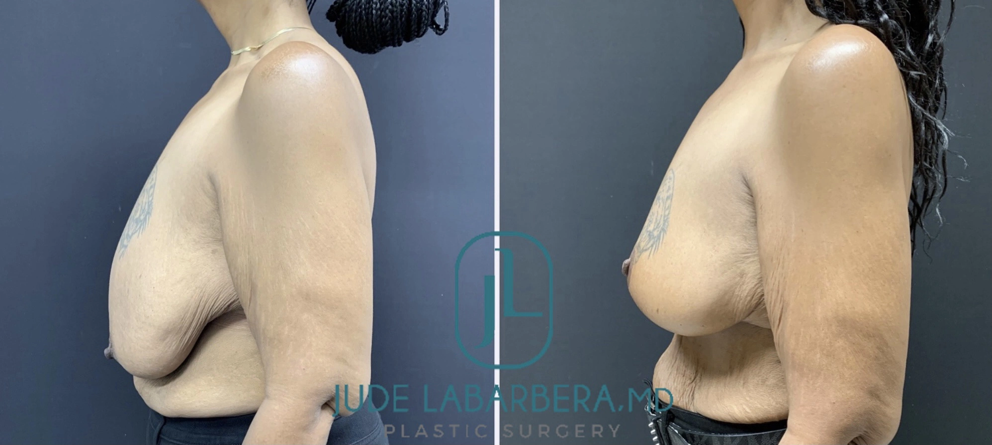 BREAST REDUCTION Before & After Case Number 0003