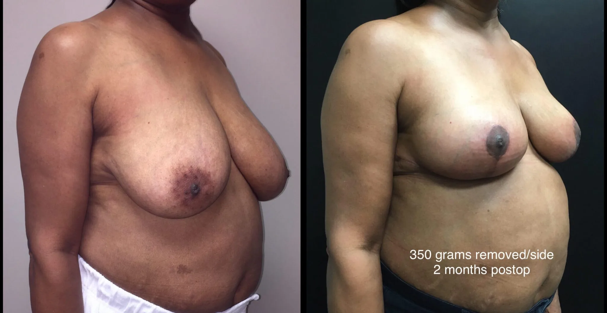 BREAST REDUCTION Before & After Case Number 0004
