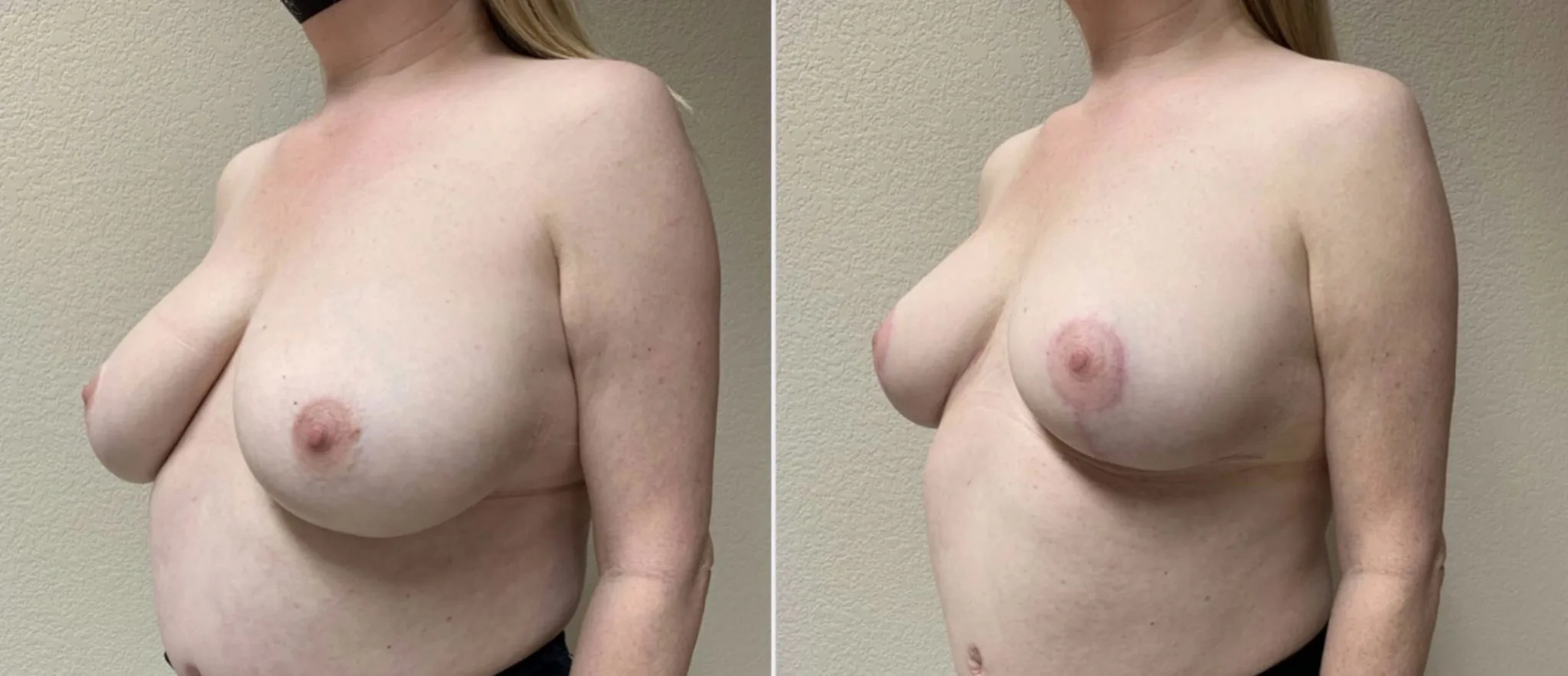 BREAST REDUCTION Before & After Case Number 0004