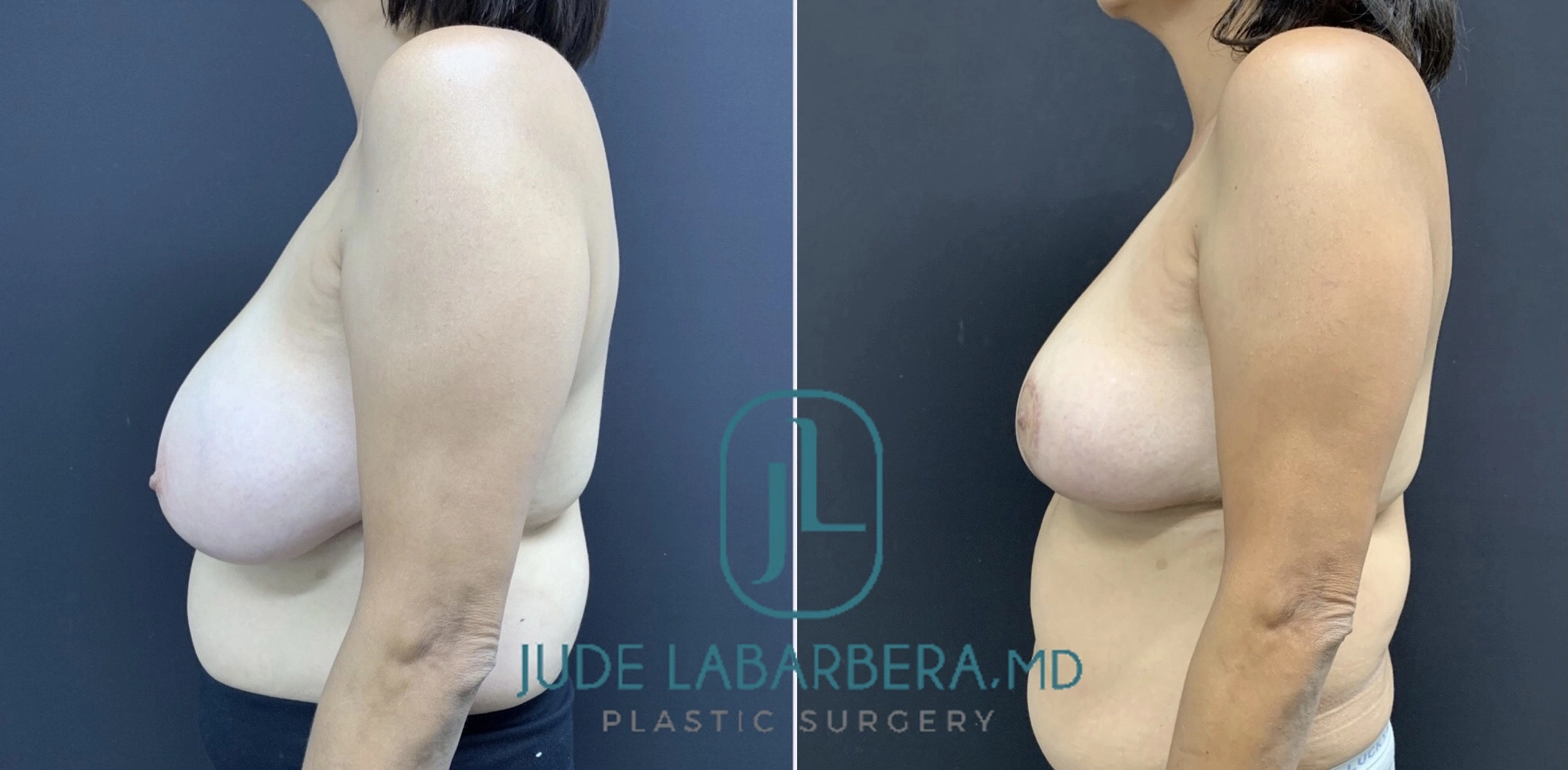 BREAST REDUCTION Before & After Case Number 0004