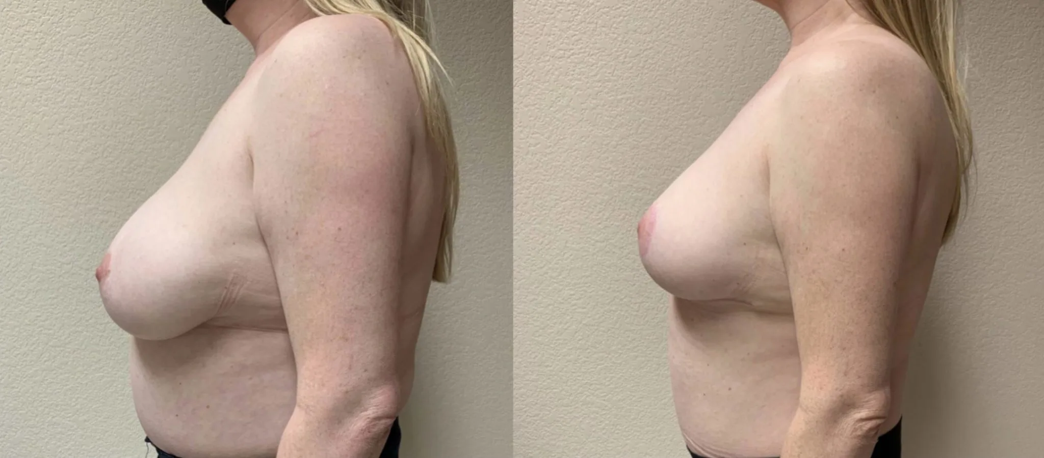BREAST REDUCTION Before & After Case Number 0004