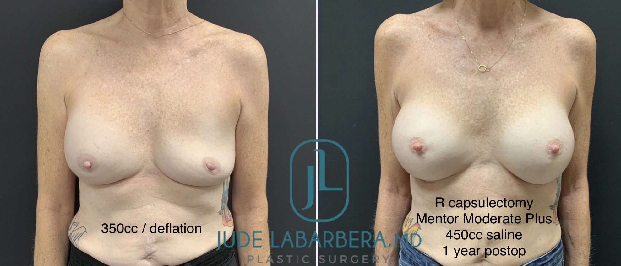 BREAST REVISION AFTER SALINE IMPLANT DEFLATION Before & After Case Number 0001