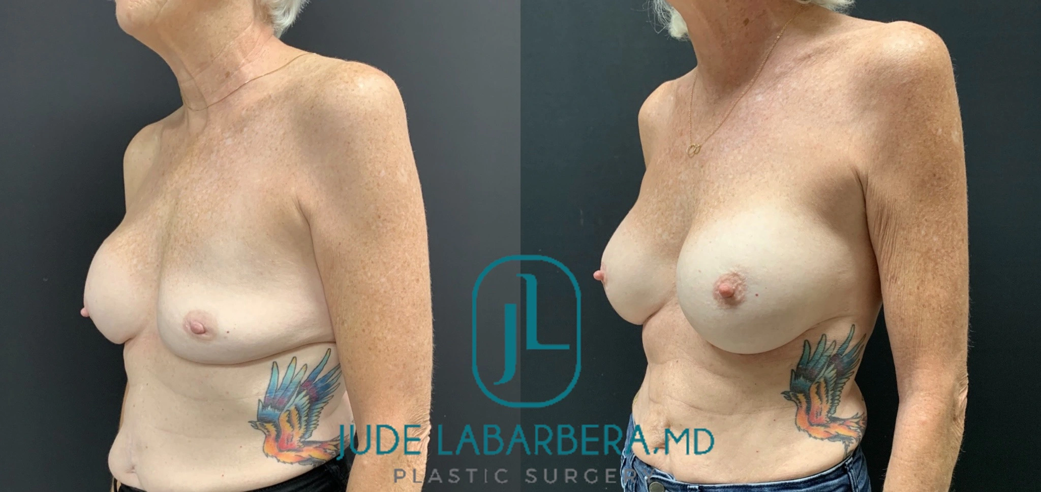 BREAST REVISION AFTER SALINE IMPLANT DEFLATION Before & After Case Number 0001