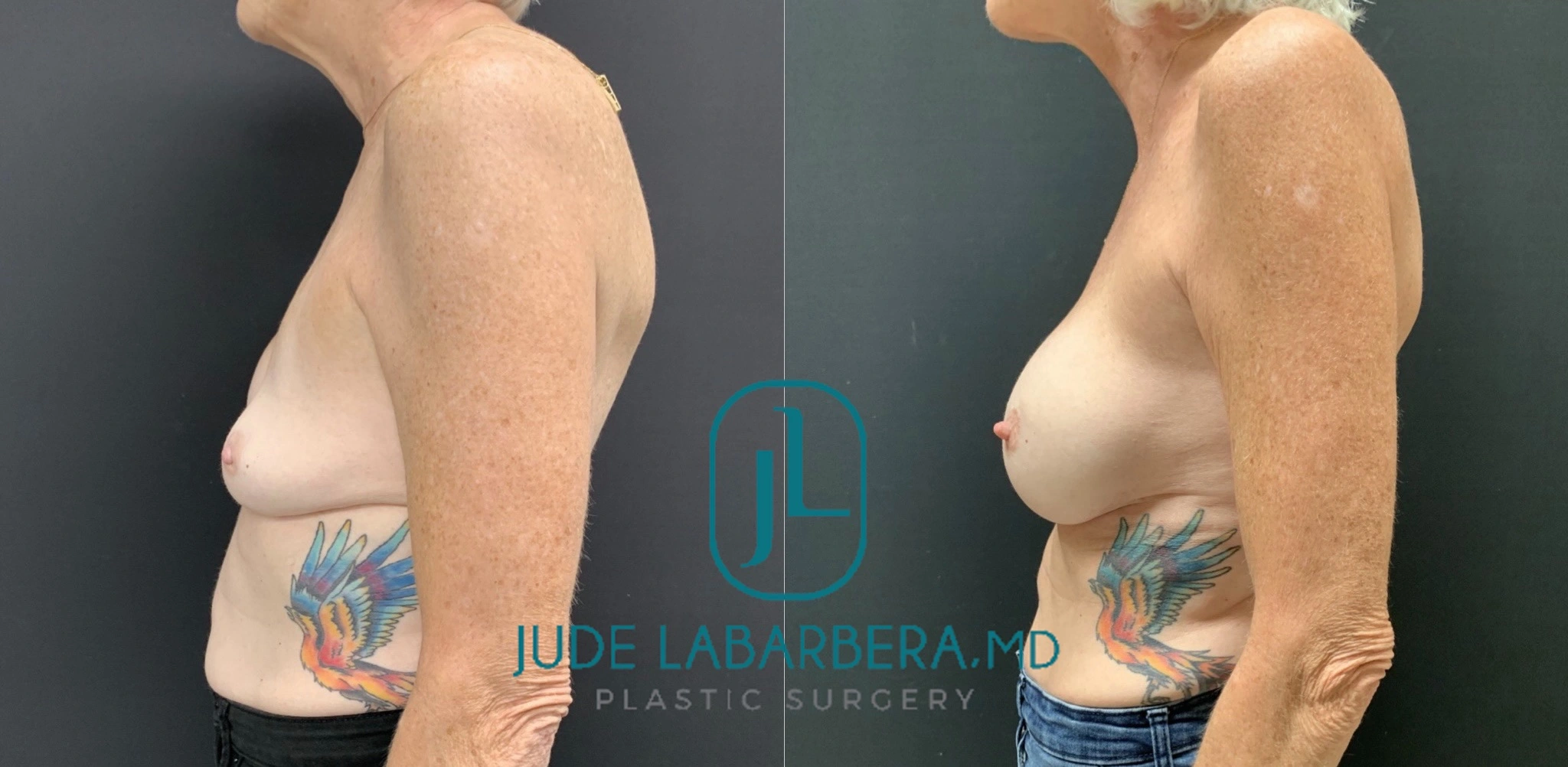 BREAST REVISION AFTER SALINE IMPLANT DEFLATION Before & After Case Number 0001