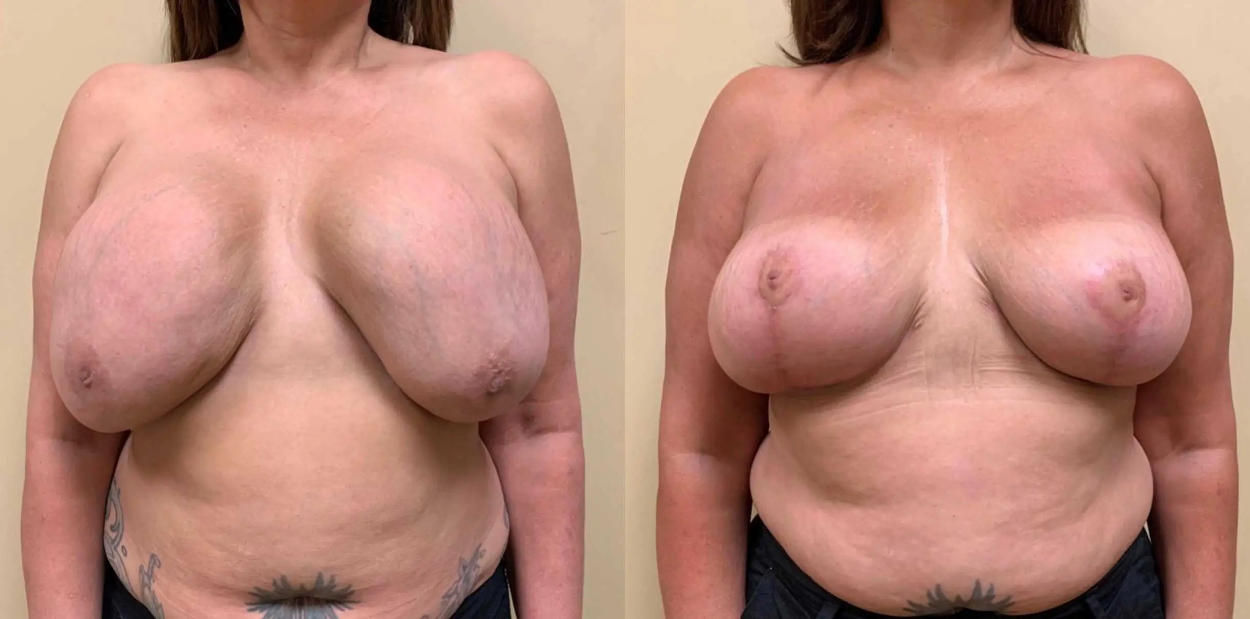 BREAST REVISION Before & After Case Number 0002