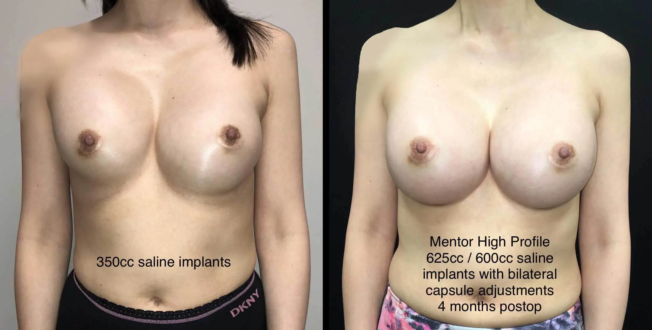 BREAST REVISION Before & After Case Number 0002
