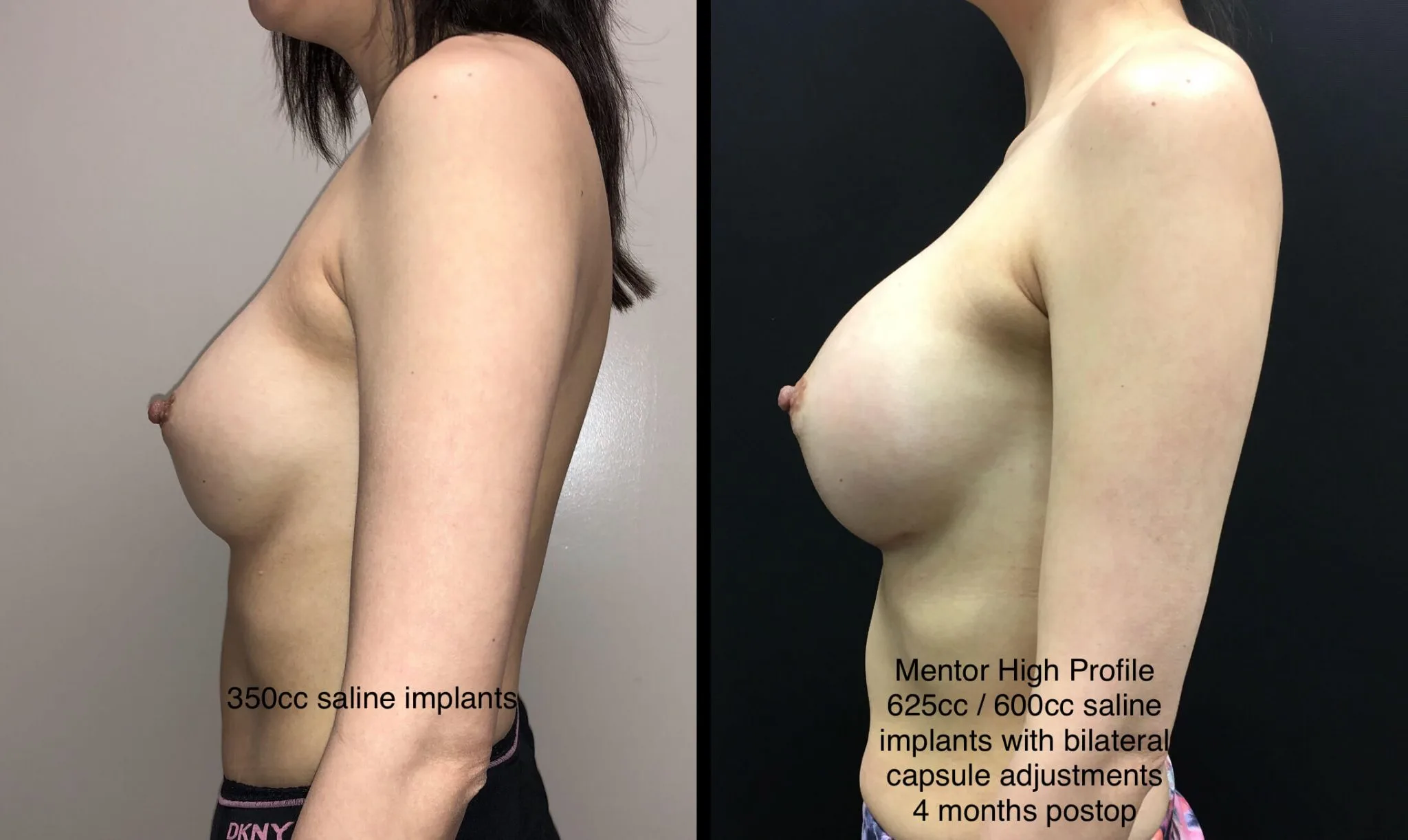 BREAST REVISION Before & After Case Number 0002