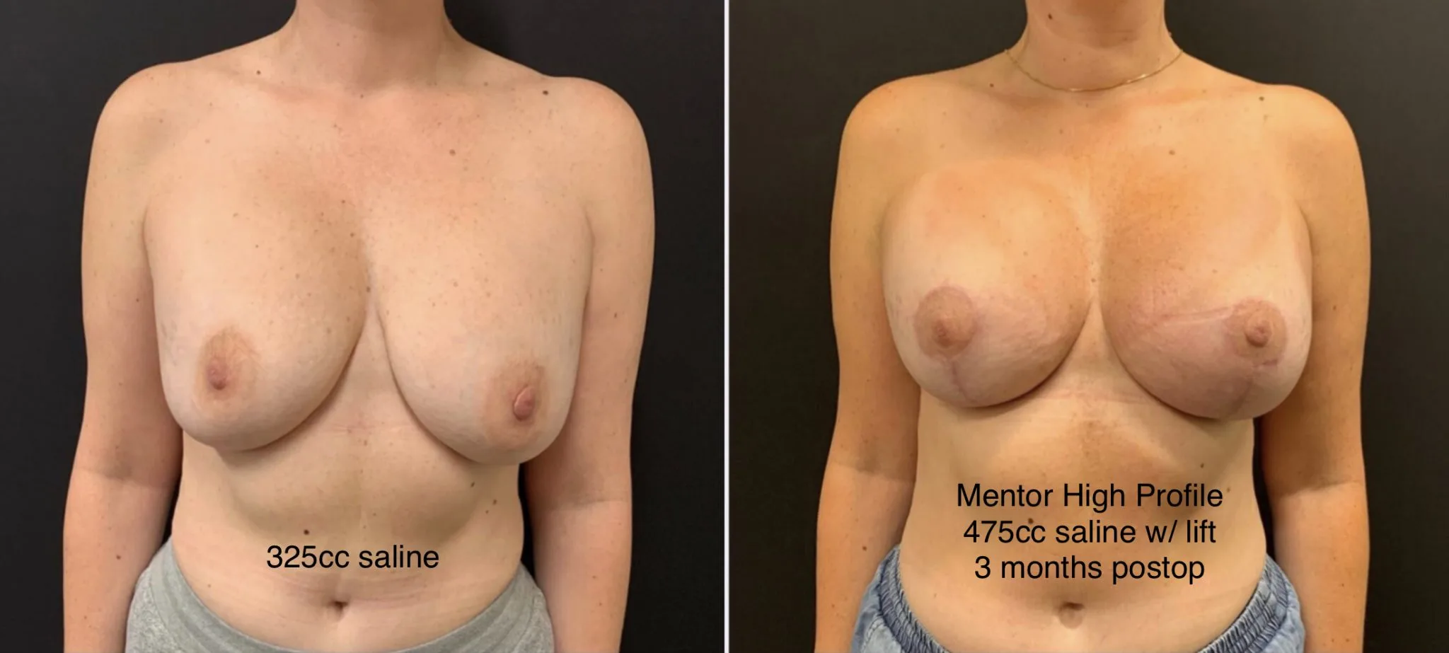 BREAST REVISION Before & After Case Number 0004