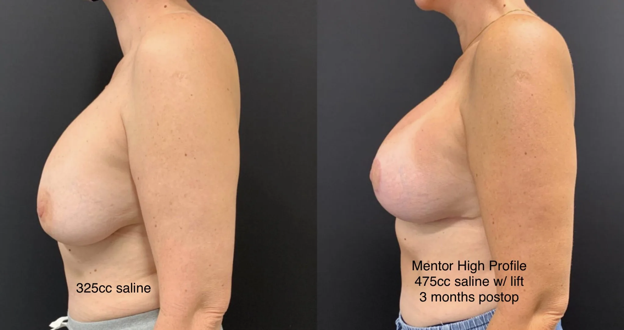 BREAST REVISION Before & After Case Number 0004